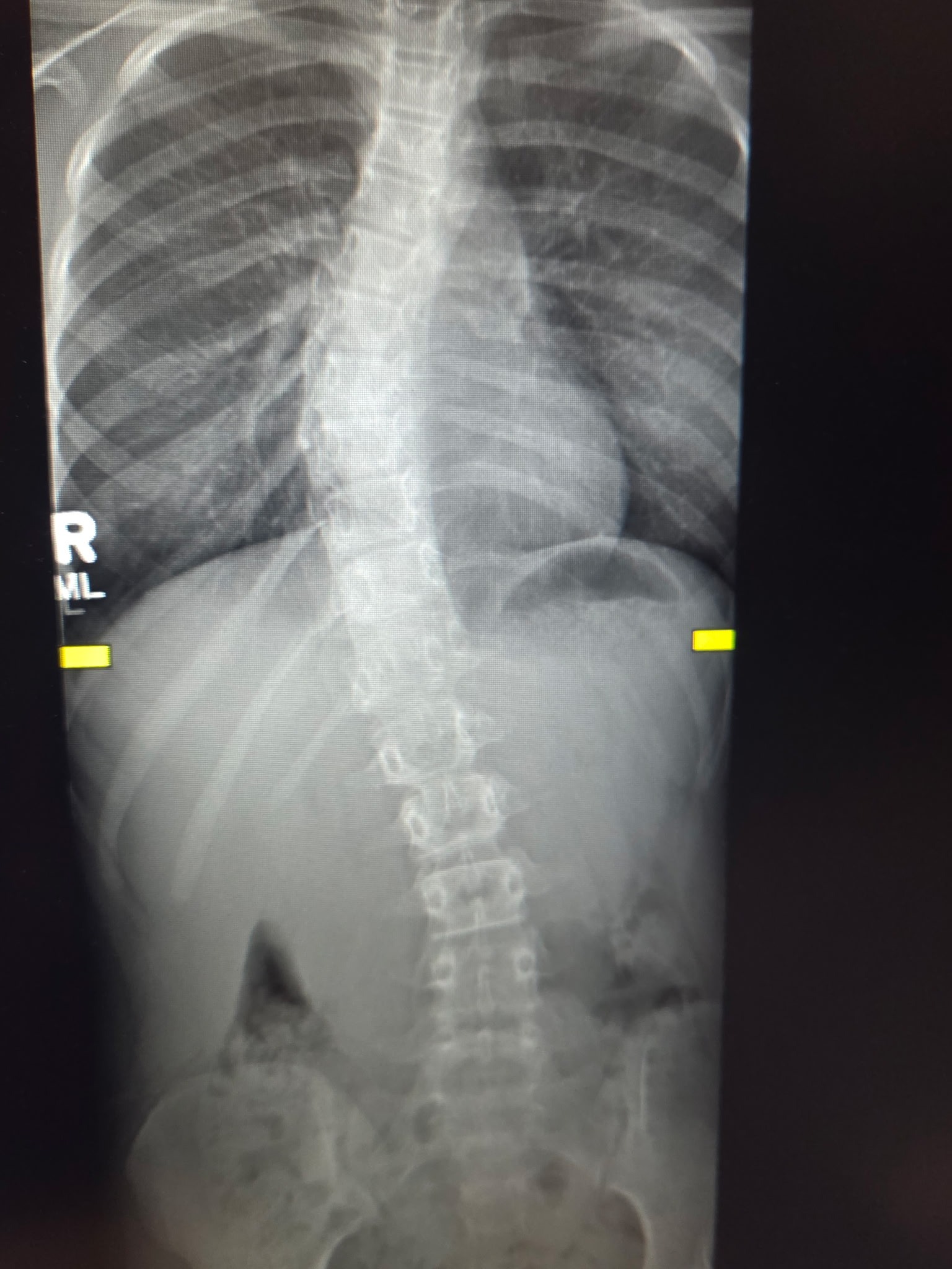 Help This Amazing Kid Get Her Scoliosis Brace and Therapy campaign photo, 4 of 7