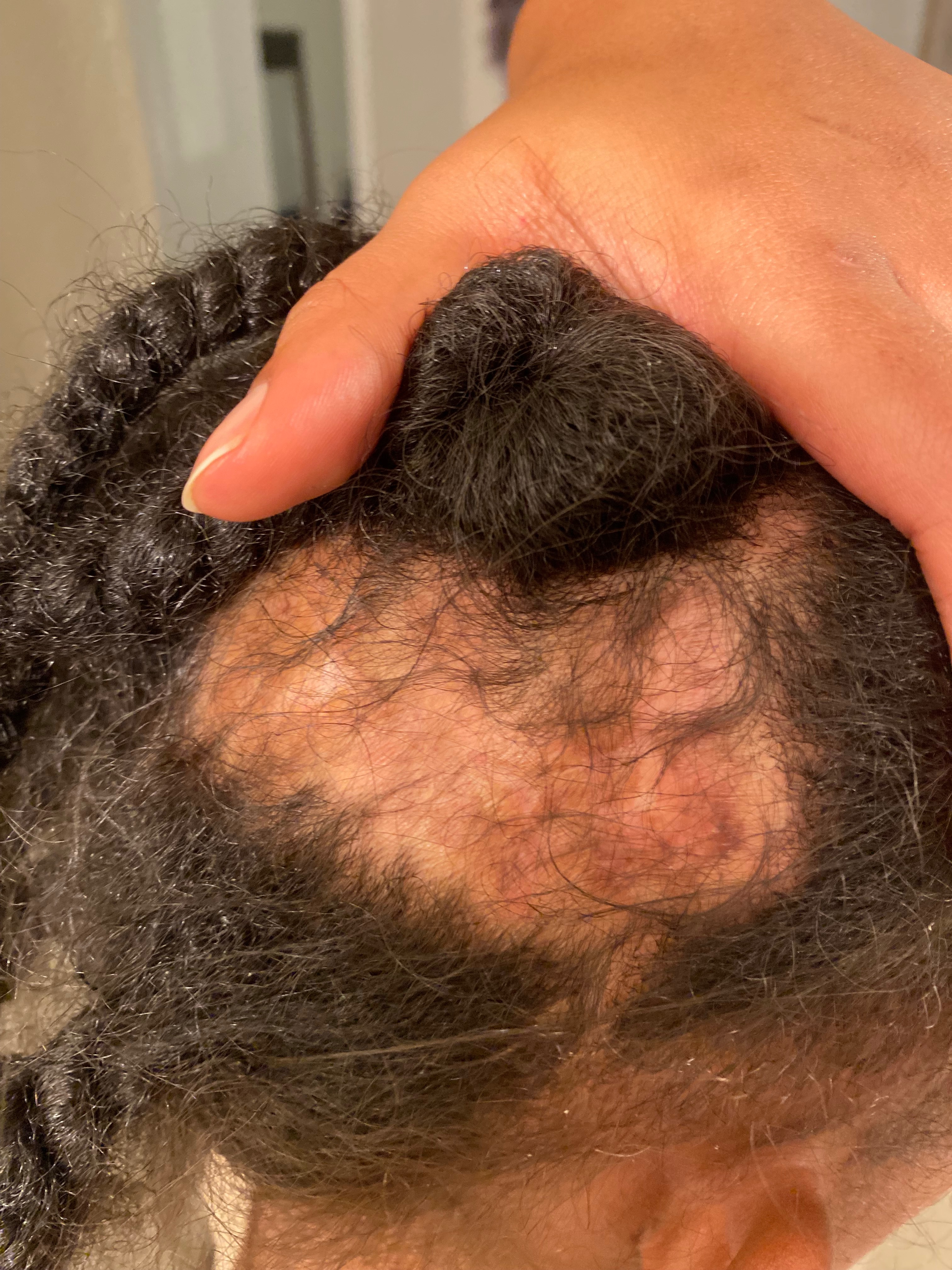 Help Sinporya Battle Discoid Lupus campaign photo, 5 of 8
