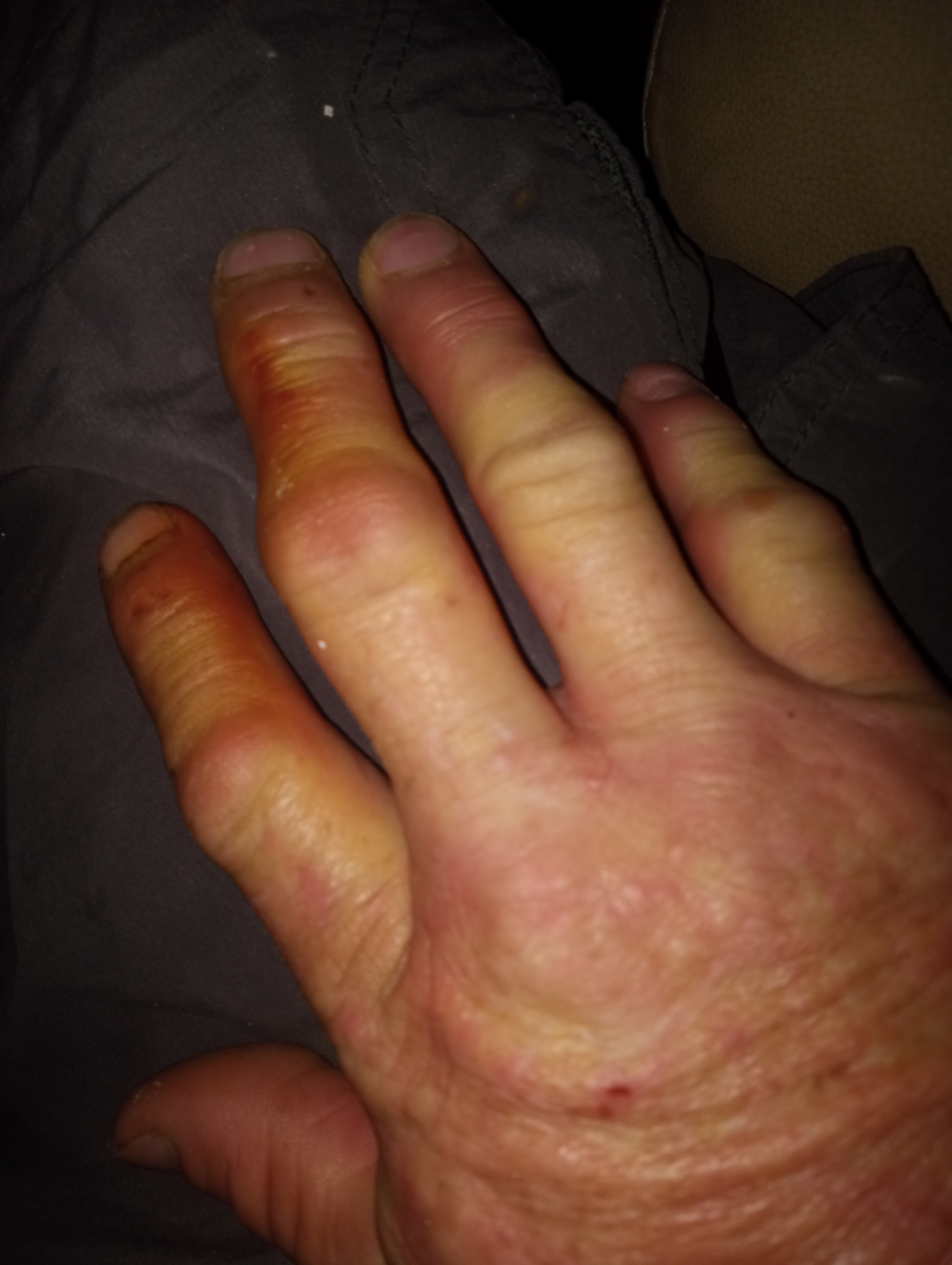 Support Richie Tubbs financially   Rare Incurable Diseases campaign photo, 2 of 4