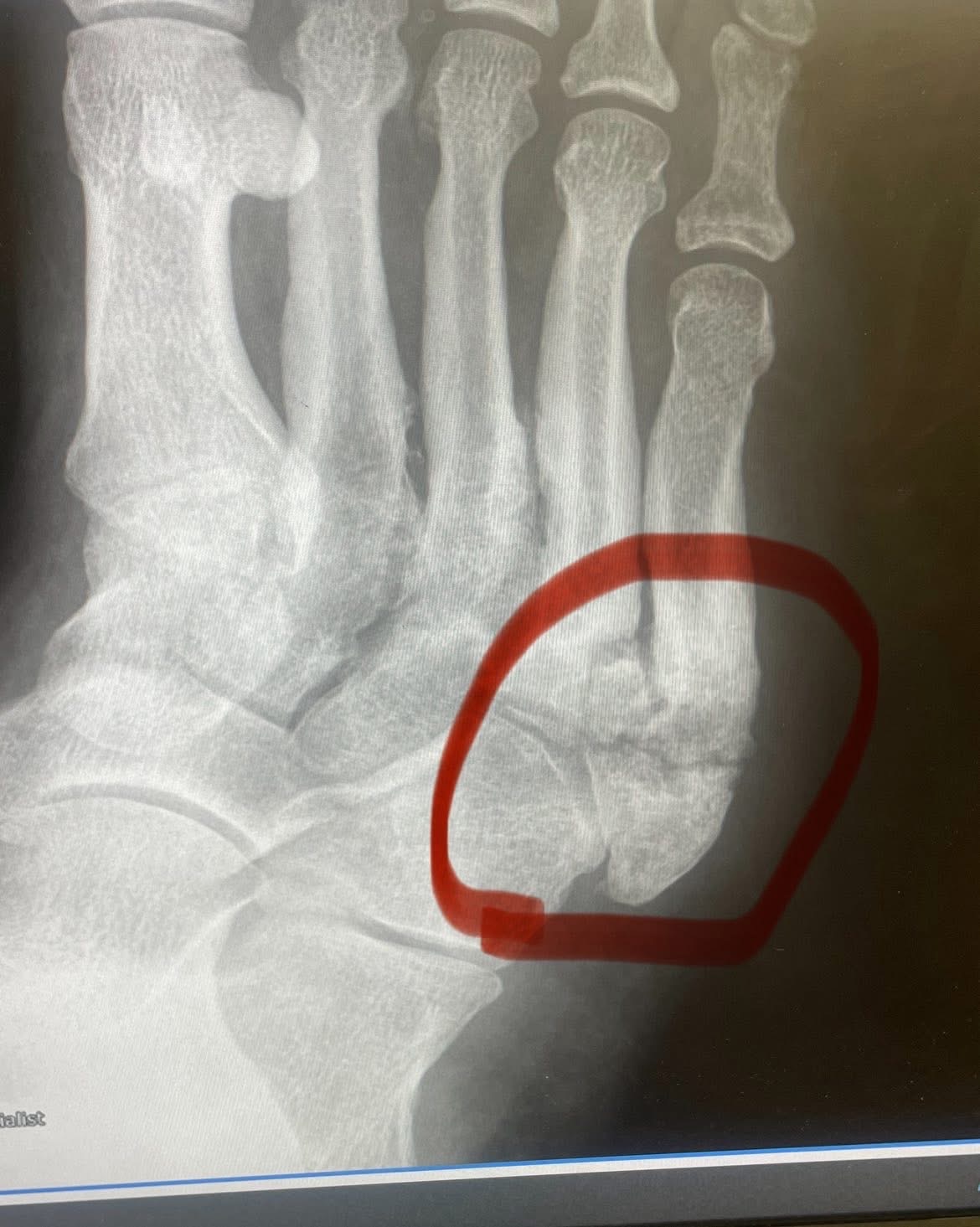 Support Chris's Recovery from Foot Injuries campaign photo, 5 of 6