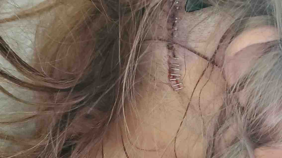 Please Support My Life-Changing Brain Surgery in Phoenix photo