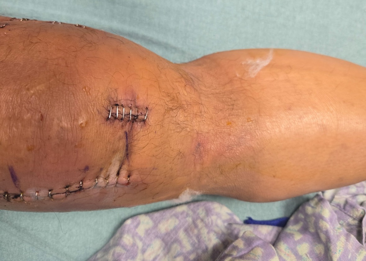 Support Joe's 3-Month Recovery Journey campaign photo, 2 of 4