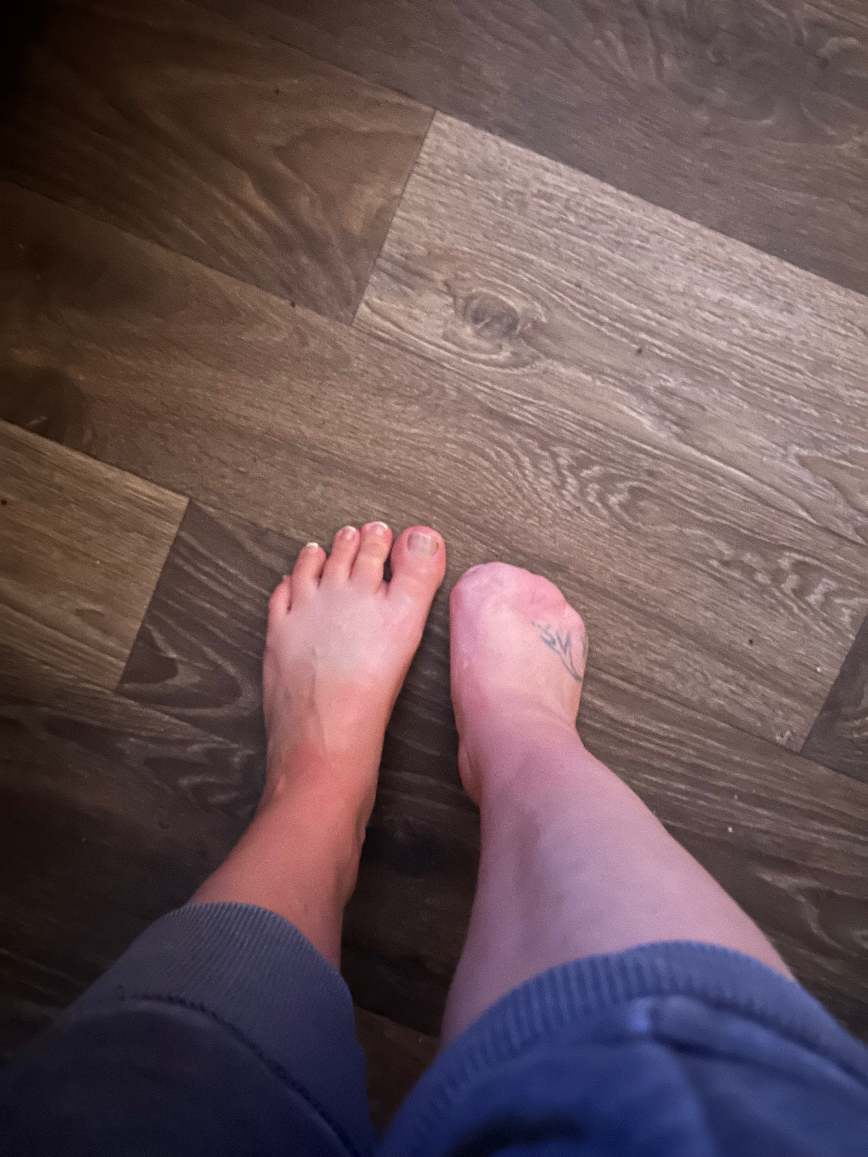 Support Recovery After Amputation campaign photo, 2 of 5