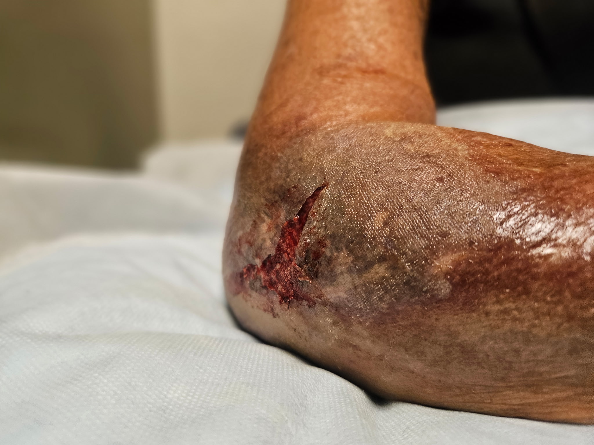 Help Anna Temple Recover from Elbow Surgery campaign photo, 2 of 8