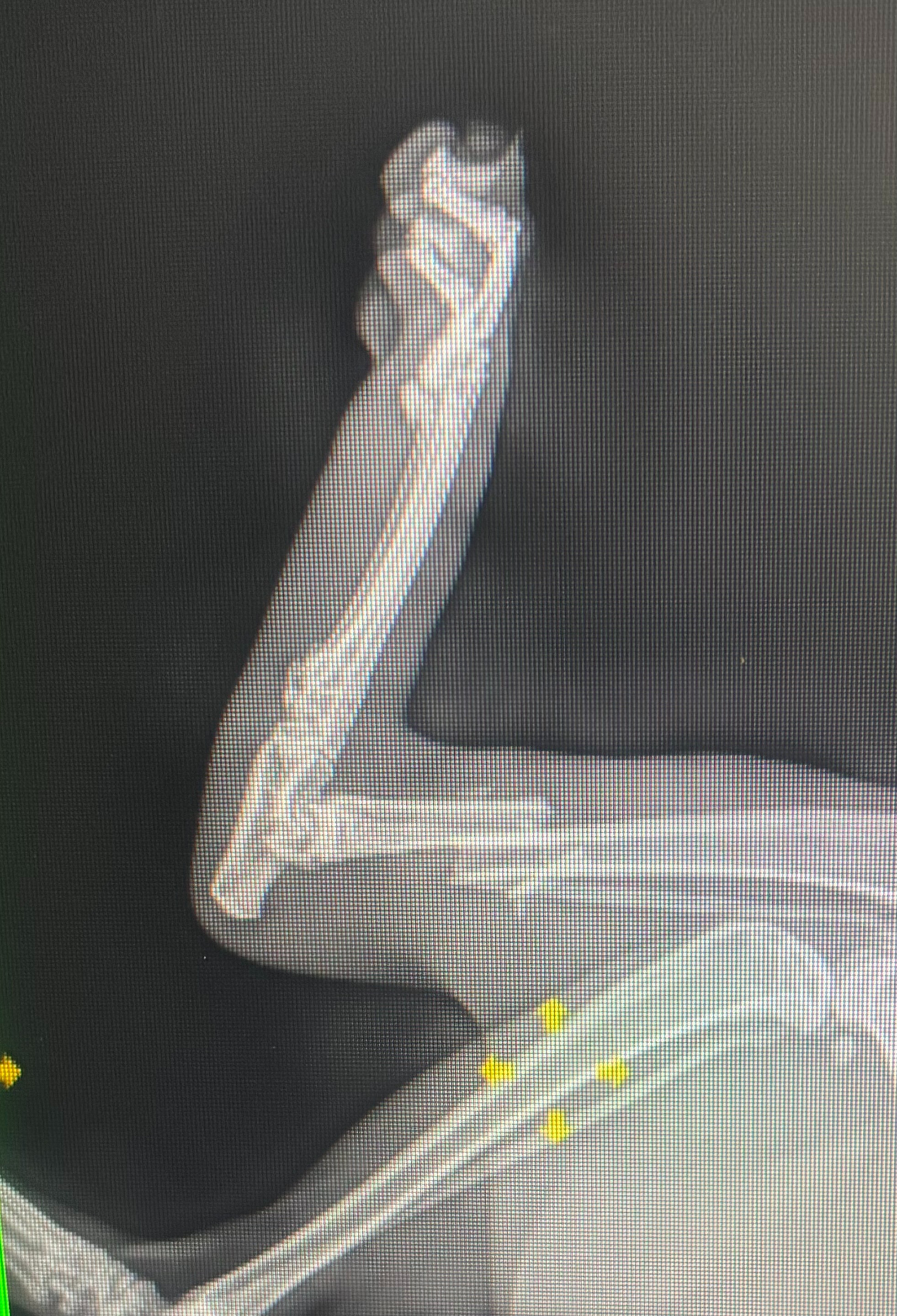 A stray's struggle: Help fix Johns fractured leg campaign photo, 2 of 4