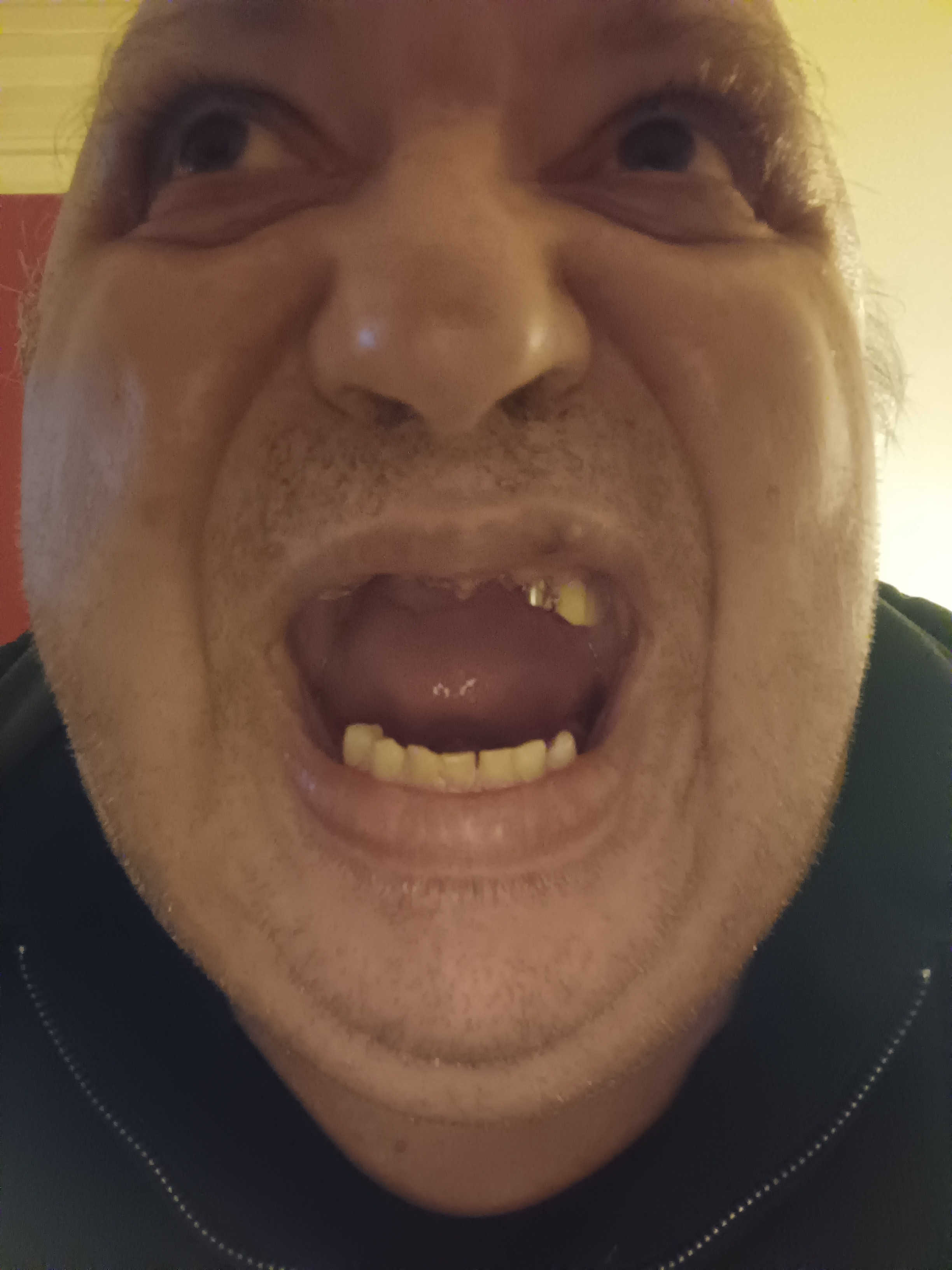Raccolta fondi per sistemare l'arcata dentale per mangiare campaign photo, 2 of 5