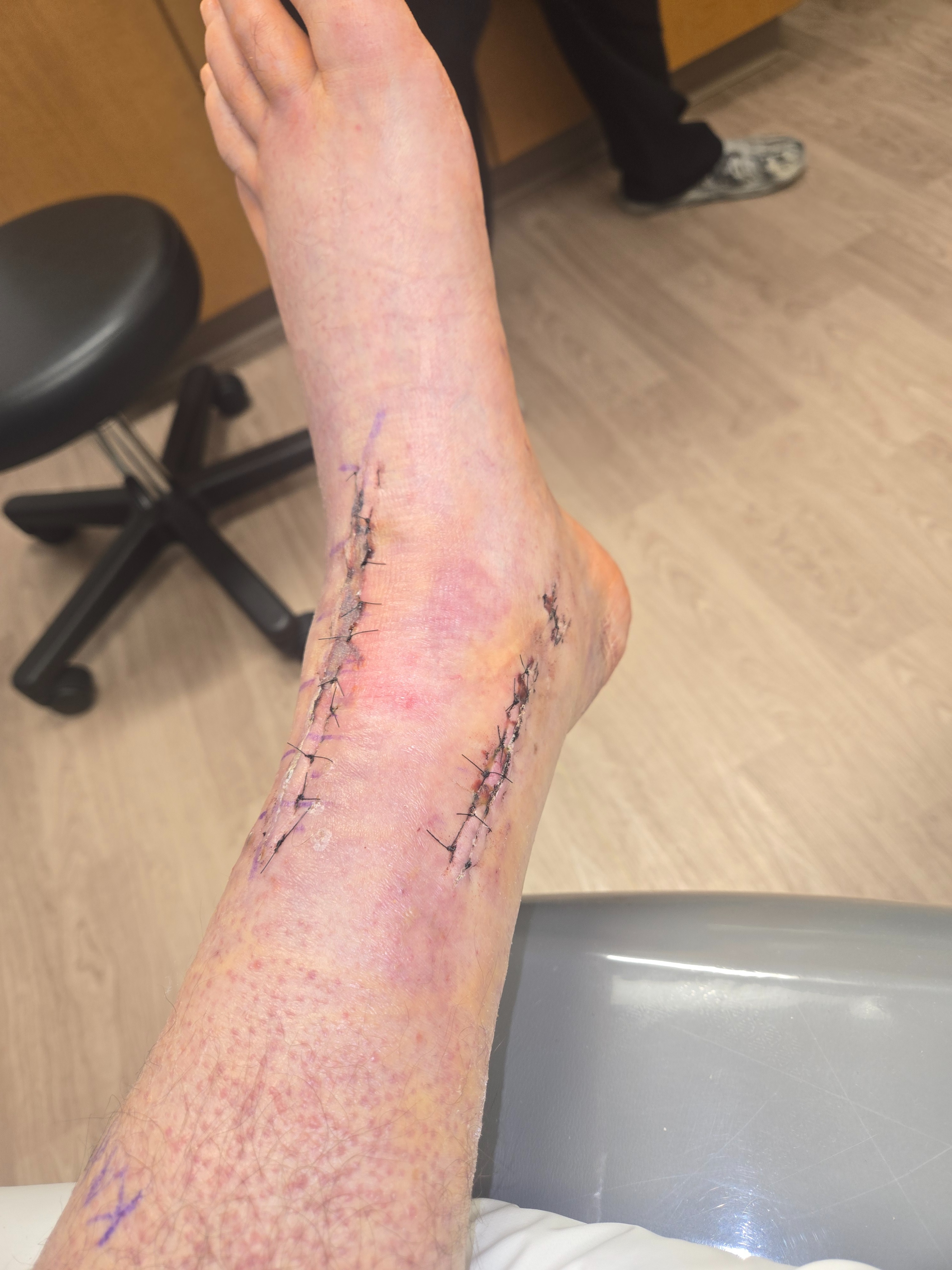 Needing some help financially after ankle surgery campaign photo, 2 of 7