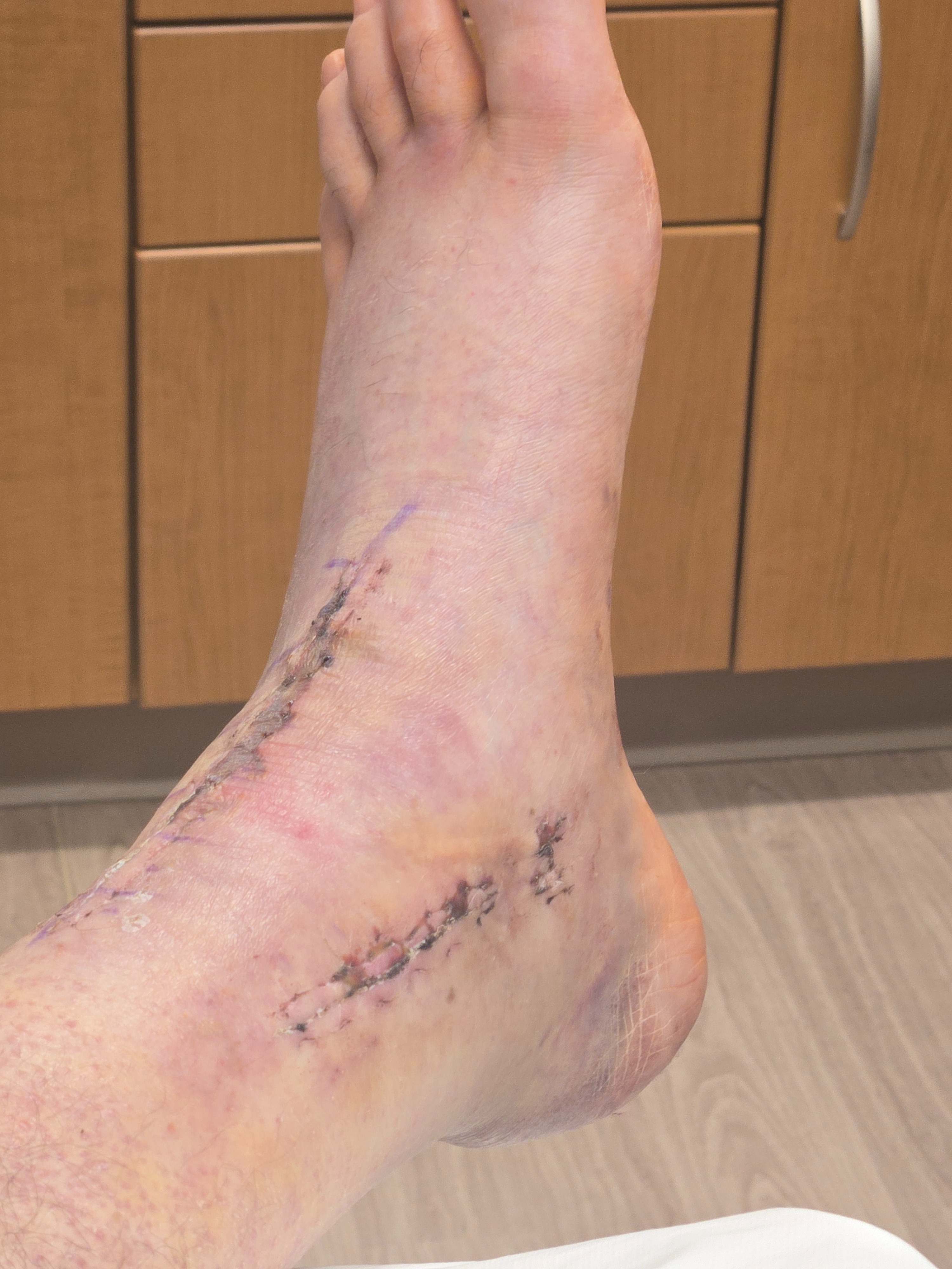 Needing some help financially after ankle surgery campaign photo, 6 of 7