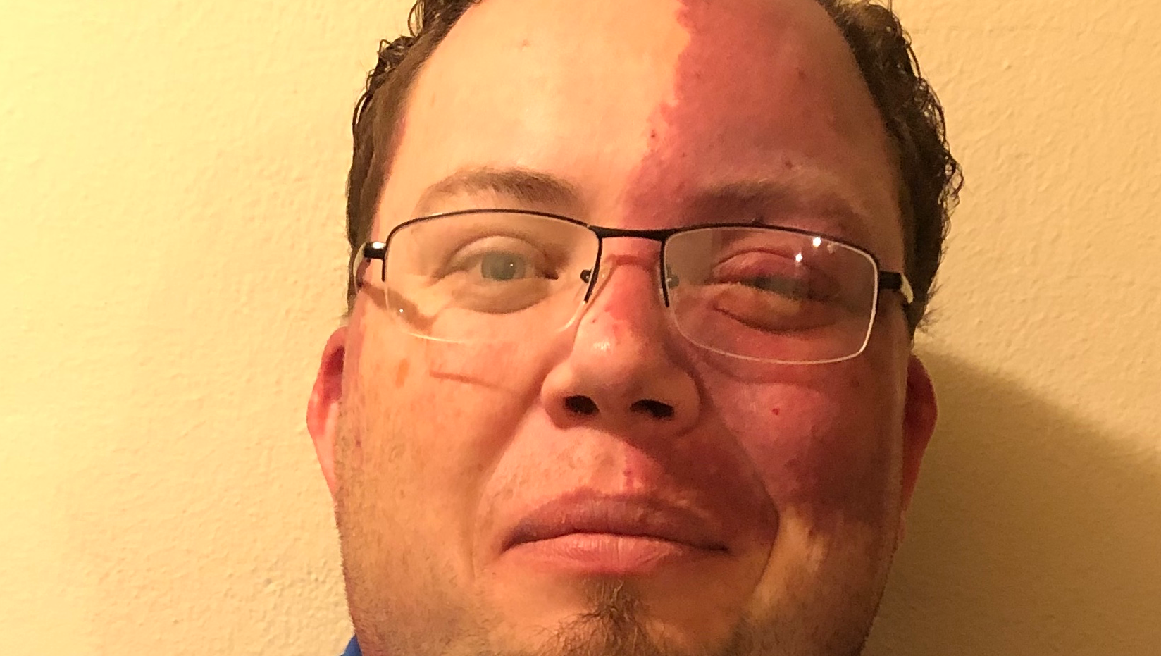 Help Phil Navigate Life with Sturge-Weber Syndrome