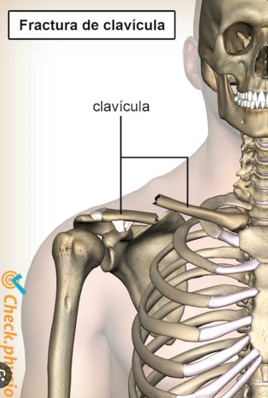 Fractura de clavícula campaign photo, 2 of 5