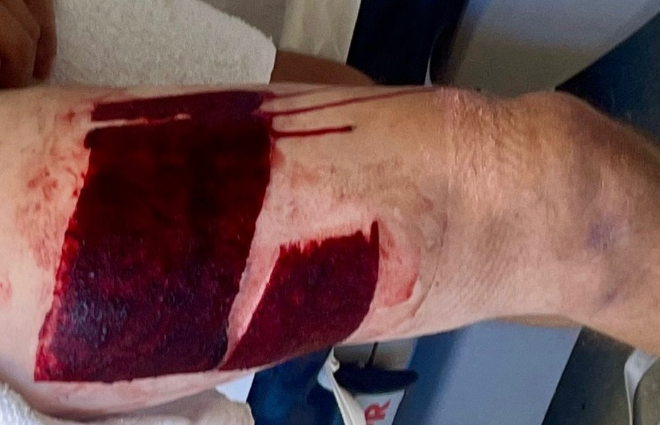 Support Andrew's Recovery from Severe Burns campaign photo, 4 of 7