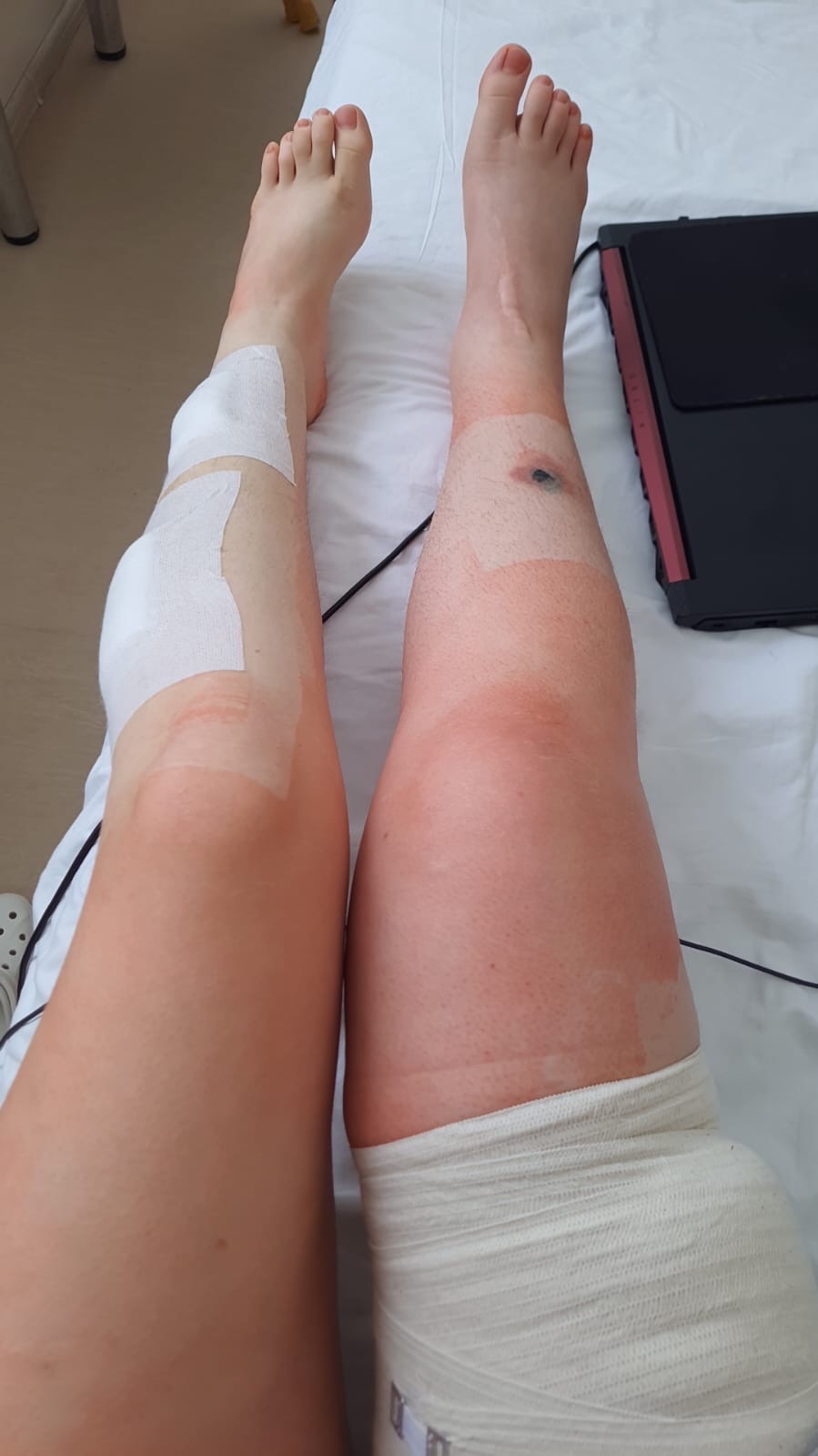 Hilfe für Angelina - Schwer verletzt nach Explosion campaign photo, 2 of 4