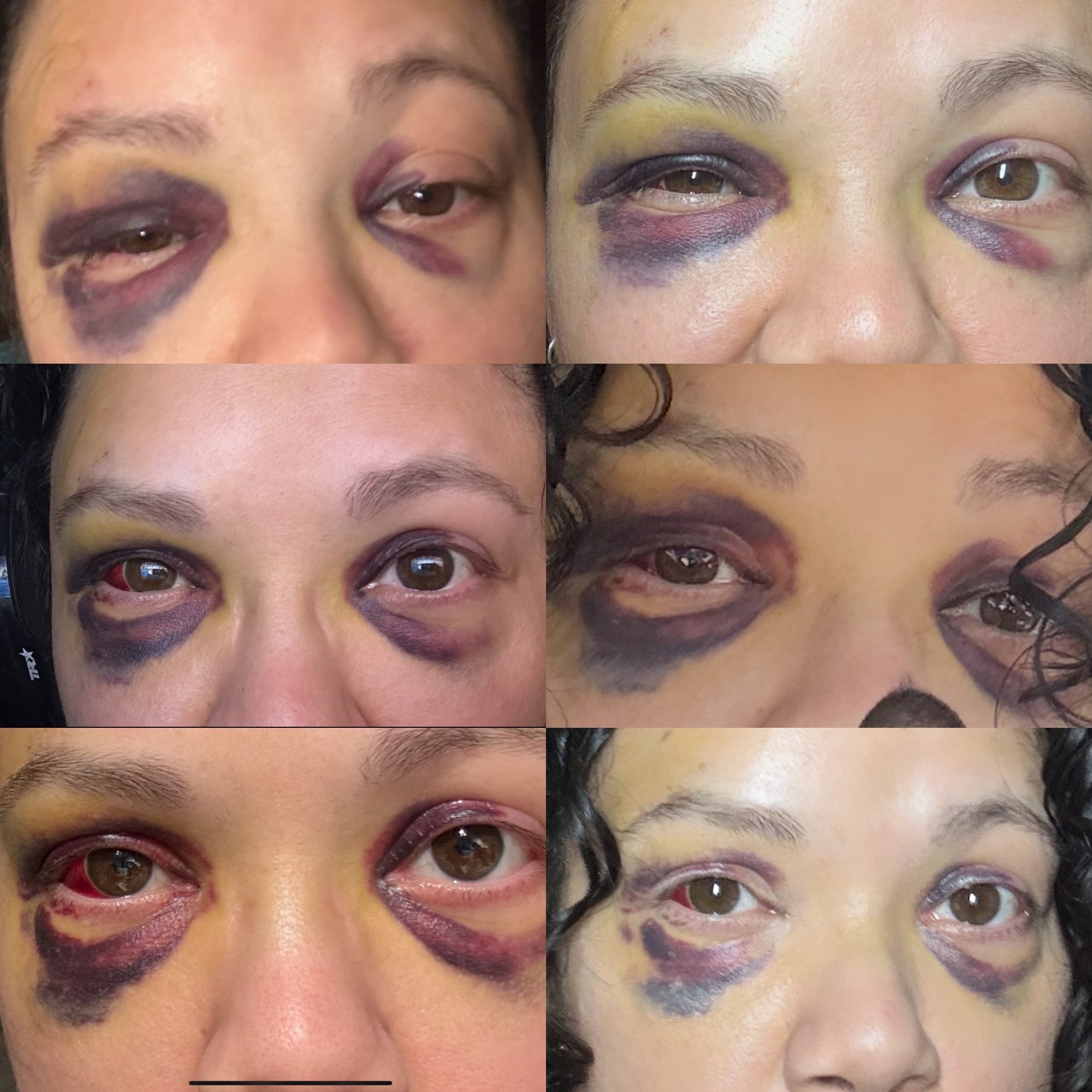 Support needed for accident recovery and missed work campaign photo, 2 of 6
