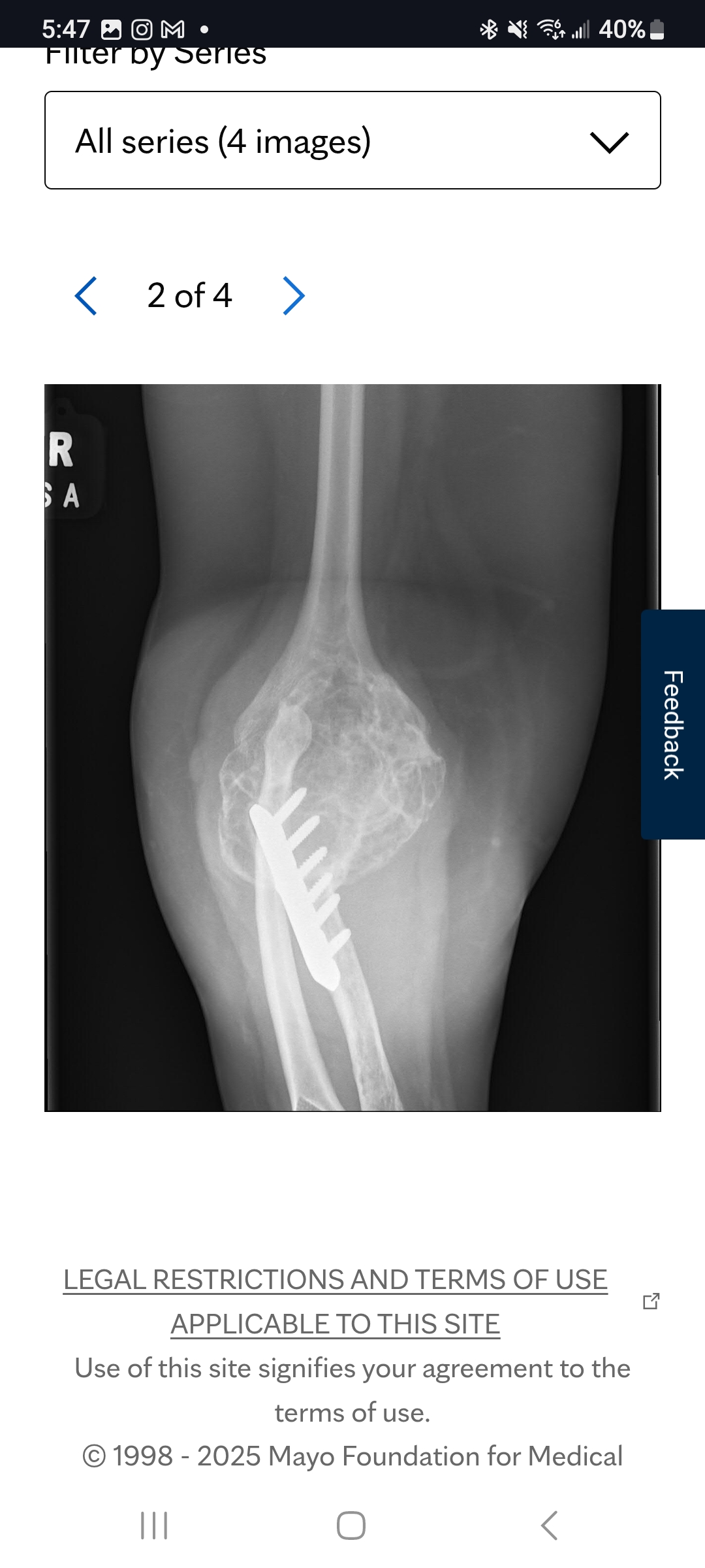 Support Julia's Elbow Surgery Recovery campaign photo, 4 of 5