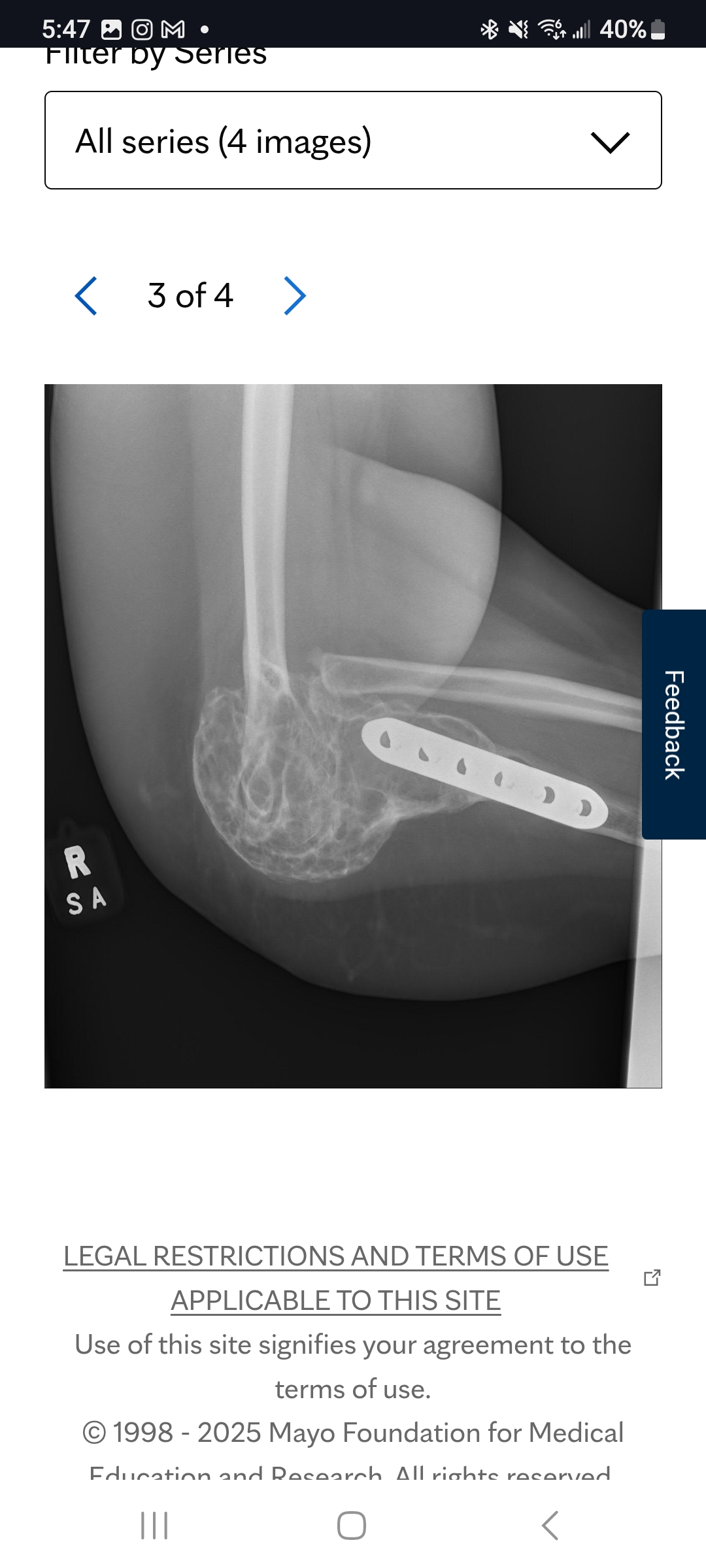 Support Julia's Elbow Surgery Recovery campaign photo, 2 of 5