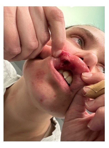 Hannah’s Autumn Fall Recovery campaign photo, 2 of 4