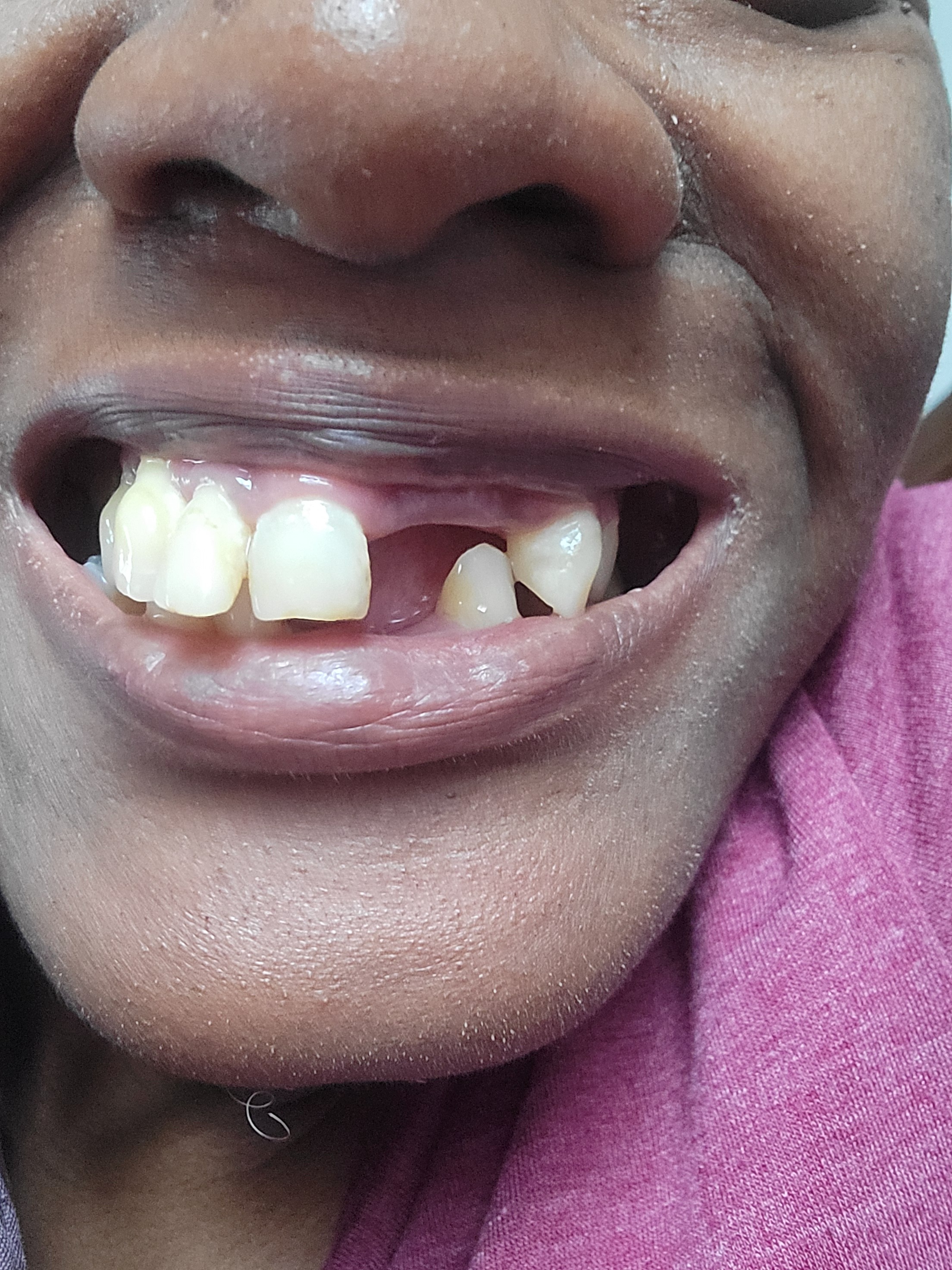 Support Needed for New Partial Denture campaign photo, 4 of 5