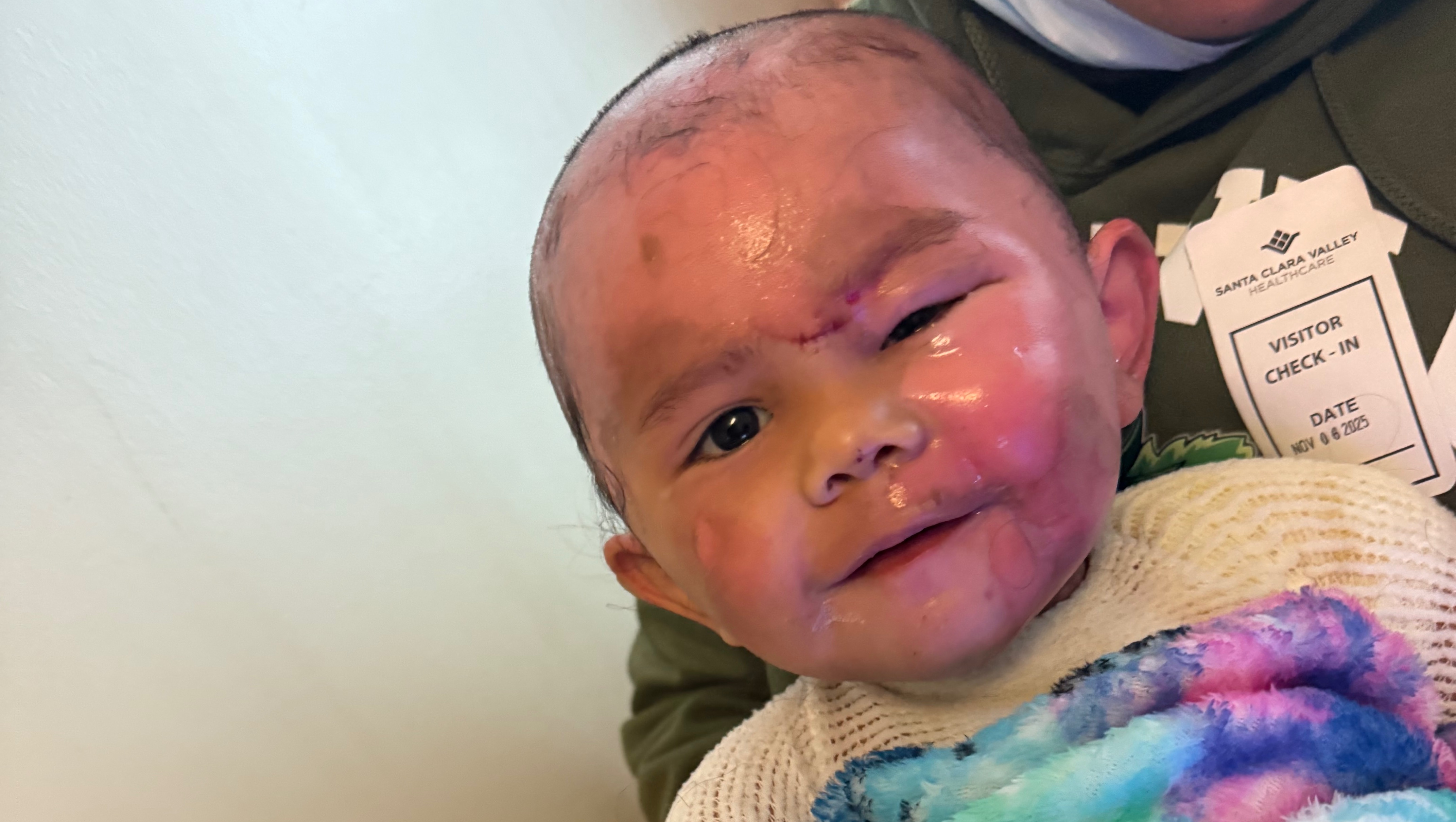 Support for Zenaida’s Burn Recovery photo