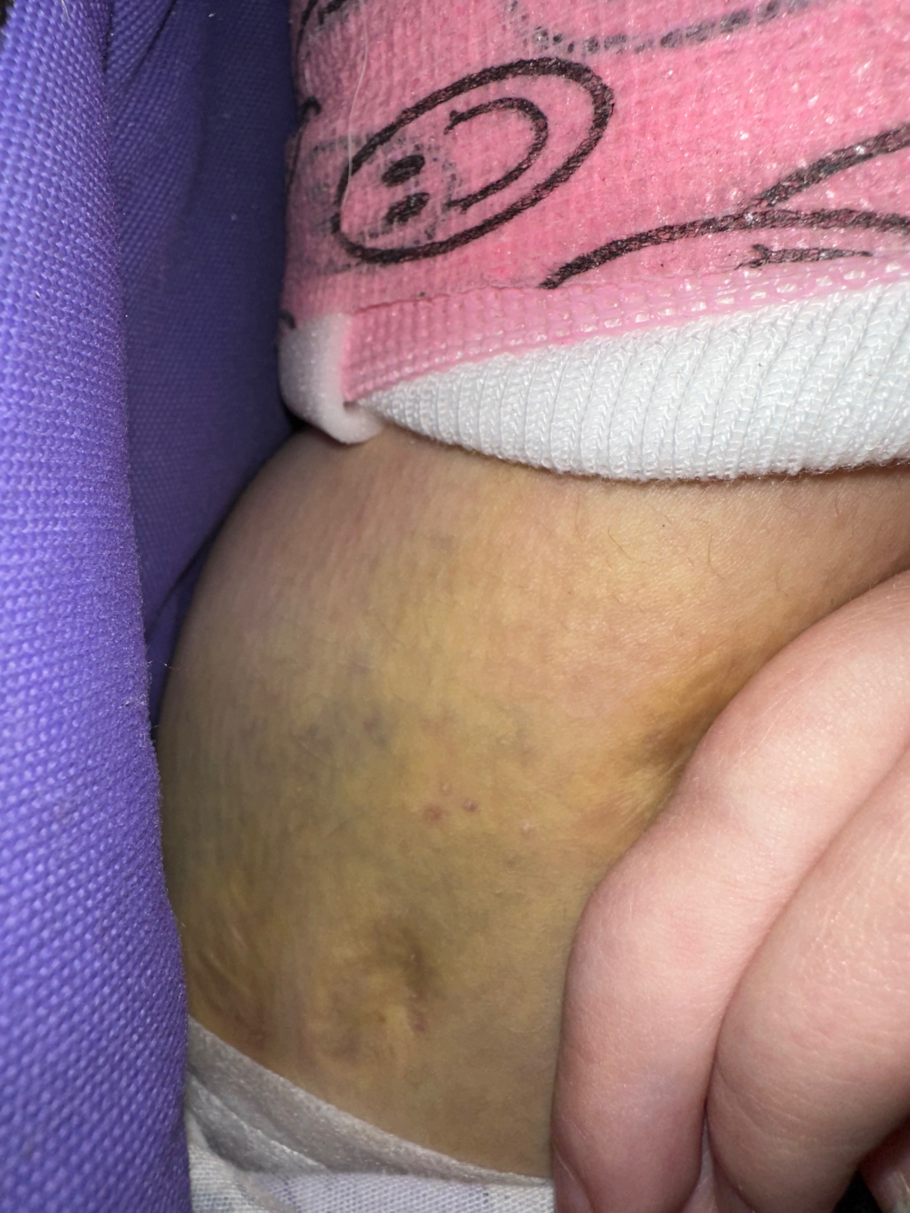 Help Avery Get to Her Final Surgery campaign photo, 5 of 7