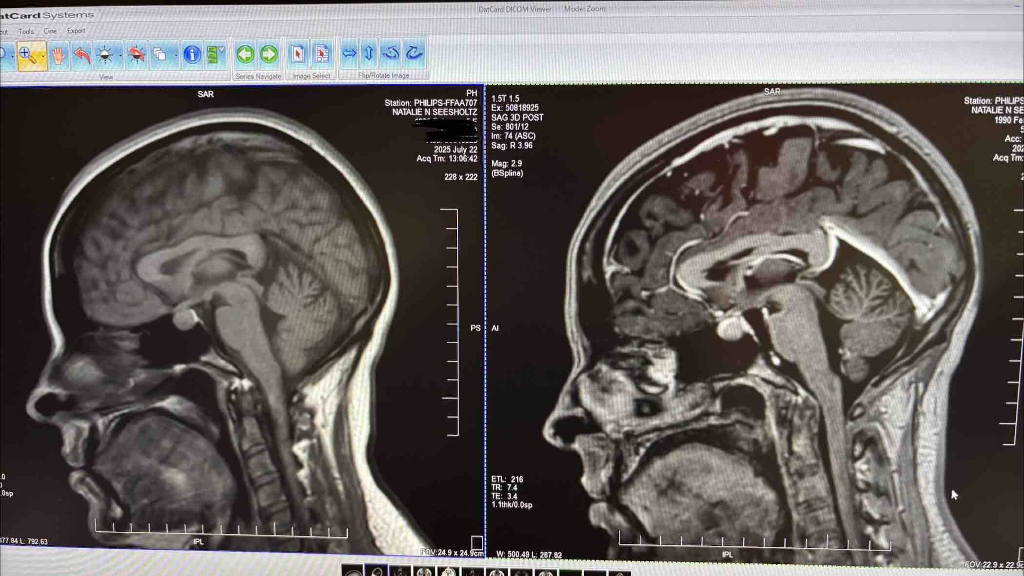 Financial support through brain surgery & recovery