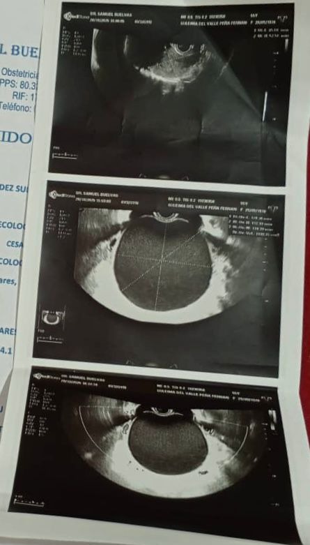 Tumoración gigante de ovario derecho campaign photo, 6 of 8