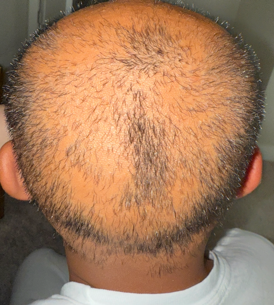 My Son Smile Again by fighting alopecia campaign photo, 2 of 7