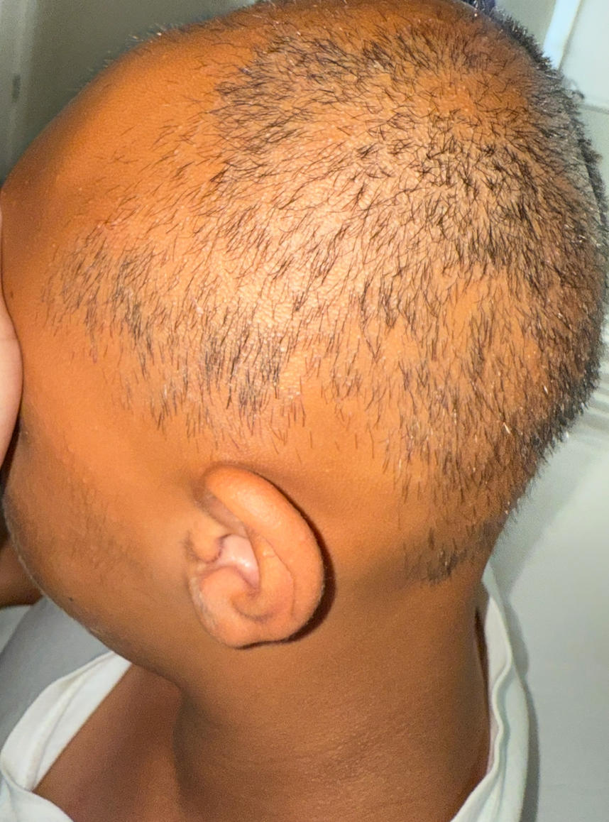 My Son Smile Again by fighting alopecia campaign photo, 4 of 7