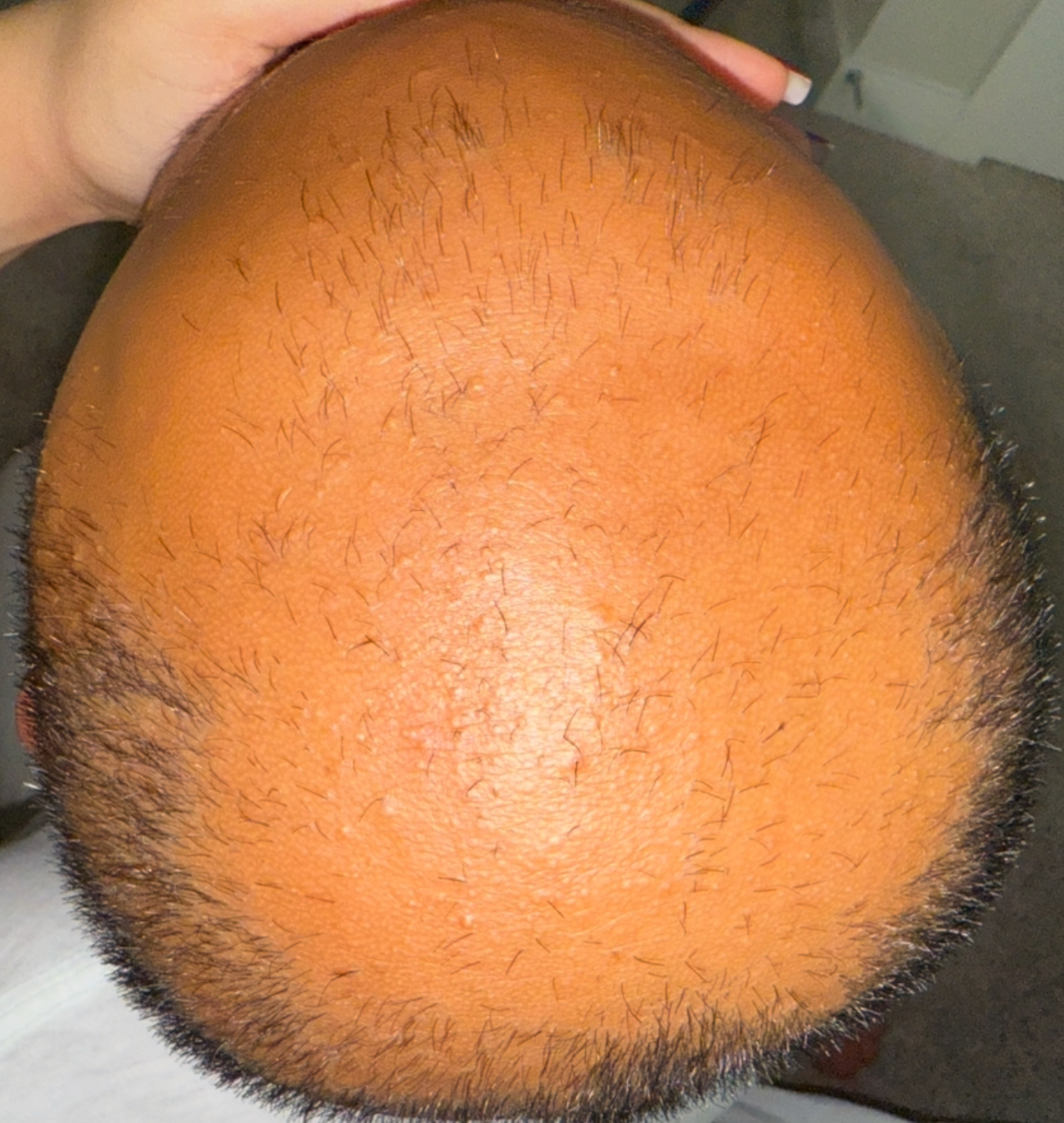 My Son Smile Again by fighting alopecia campaign photo, 5 of 7