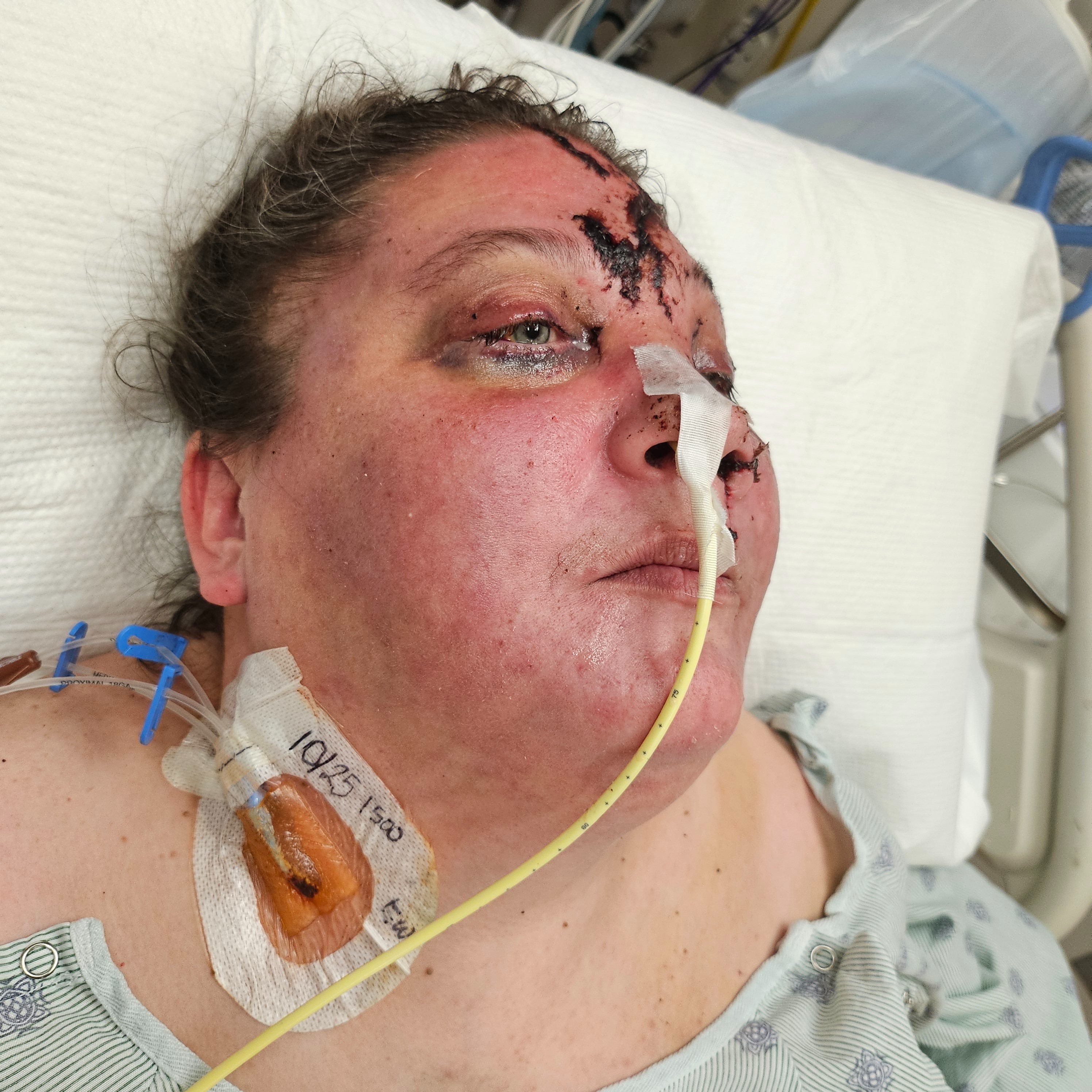Help Amy Recover from Severe Accident campaign photo, 4 of 5