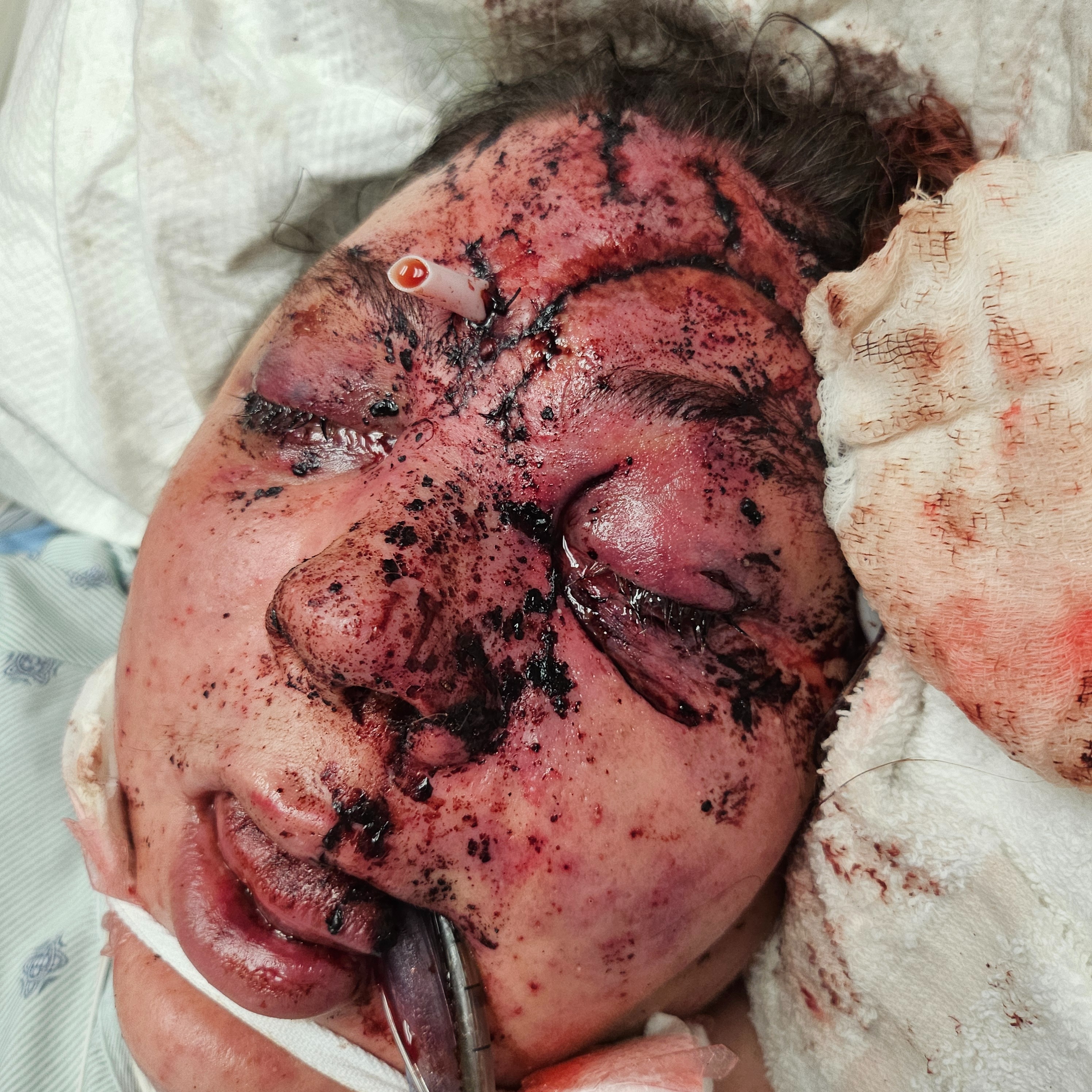 Help Amy Recover from Severe Accident campaign photo, 2 of 5