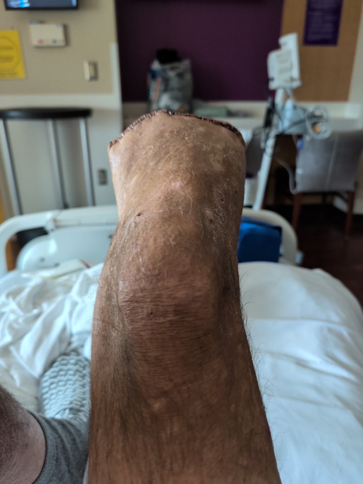 Help Dad Fight MRSA and Amputation campaign photo, 2 of 8