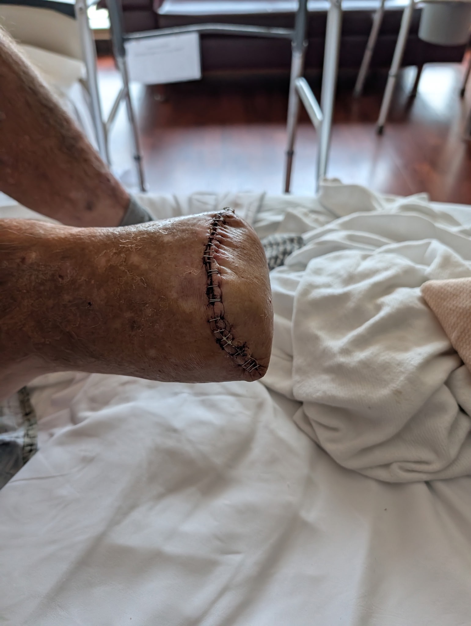 Help Dad Fight MRSA and Amputation campaign photo, 7 of 8