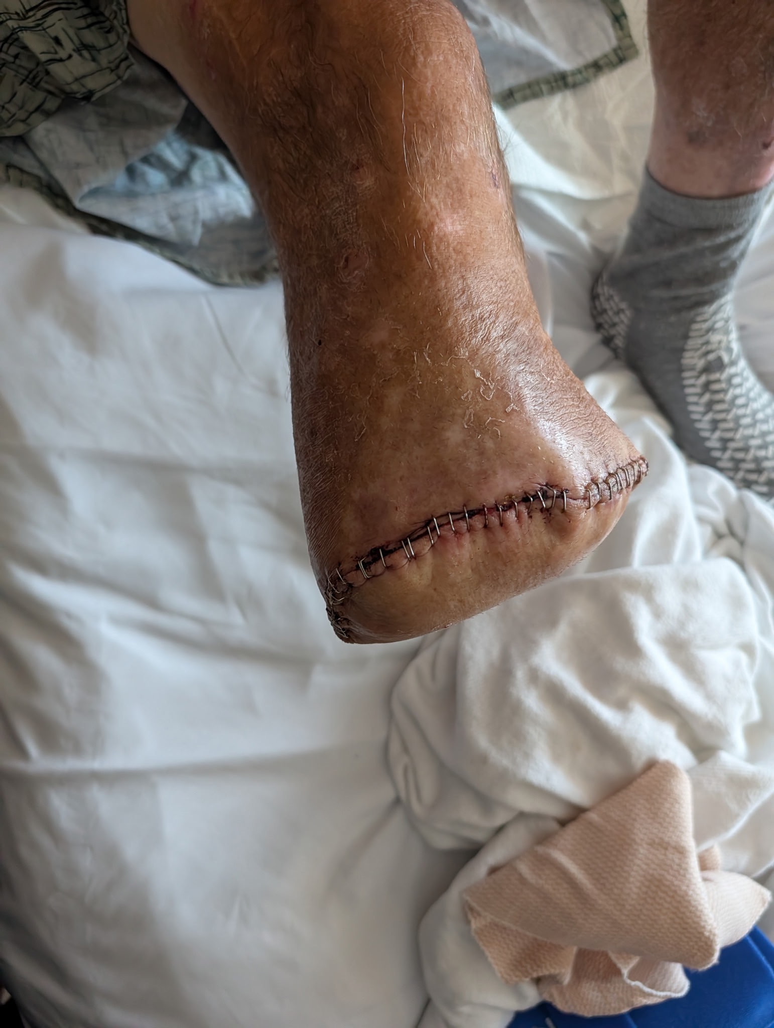 Help Dad Fight MRSA and Amputation campaign photo, 4 of 8