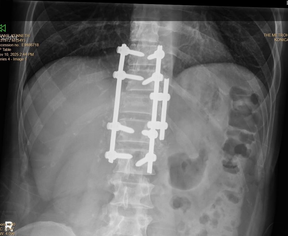 Support us as our Dad Recovers from Spinal Cord Injury campaign photo, 5 of 6