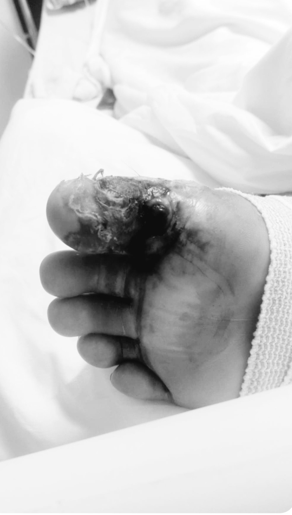 Help Lucilo Recover After Amputation campaign photo, 4 of 7