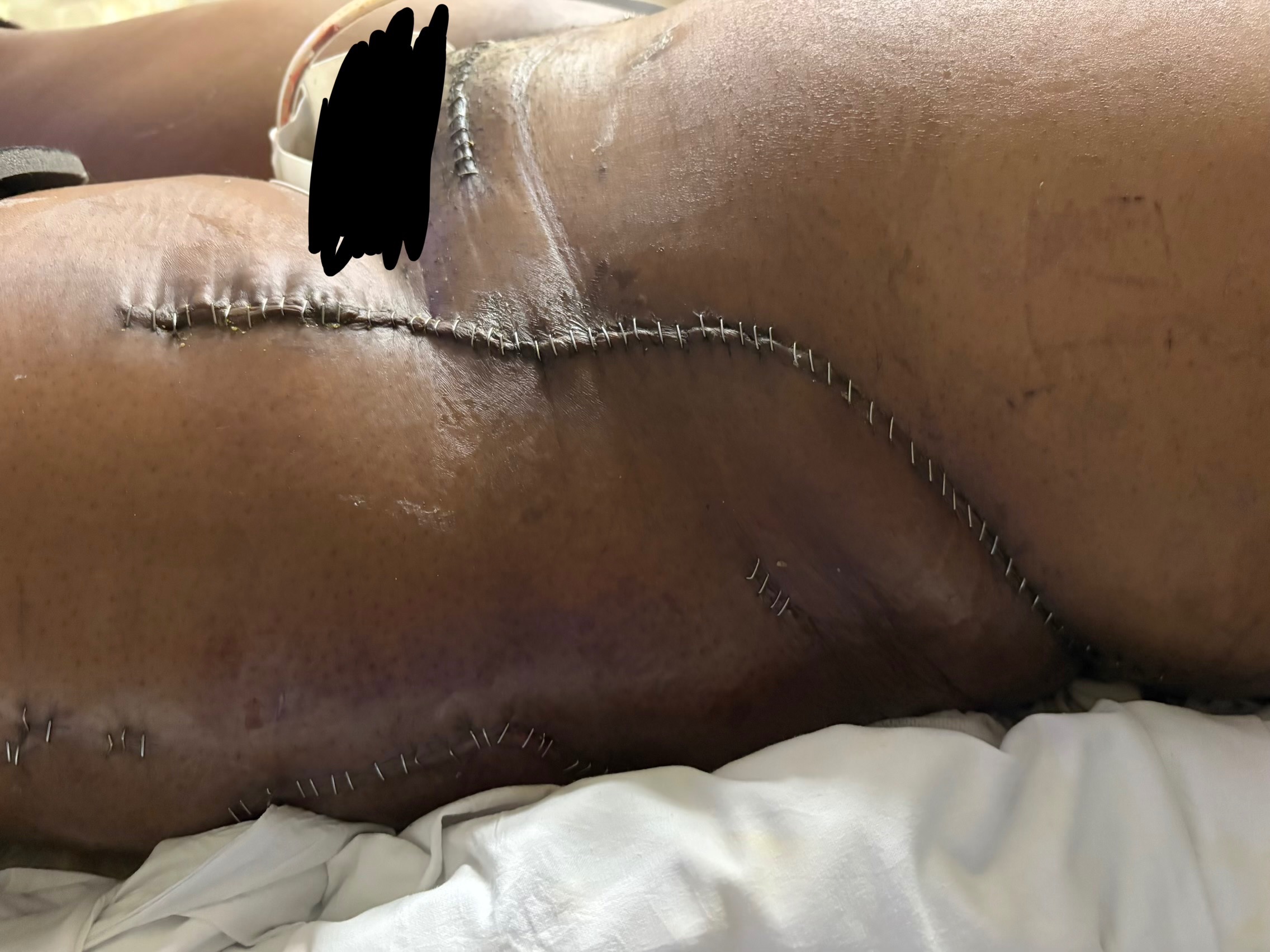 Support Armanae On Her Road to Recovery campaign photo, 4 of 6