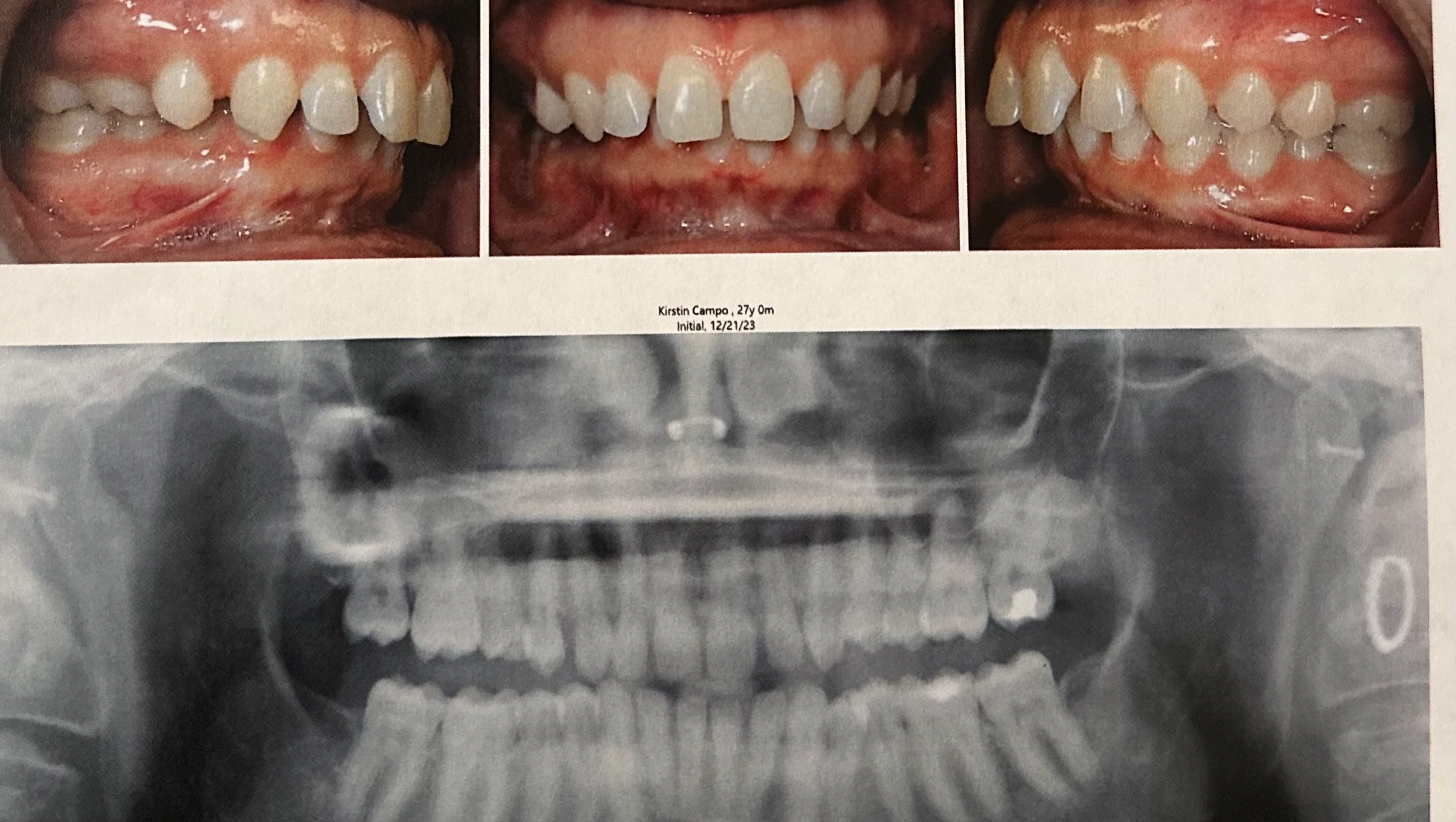 Help Kirstin Afford Life-Changing Jaw Surgery photo