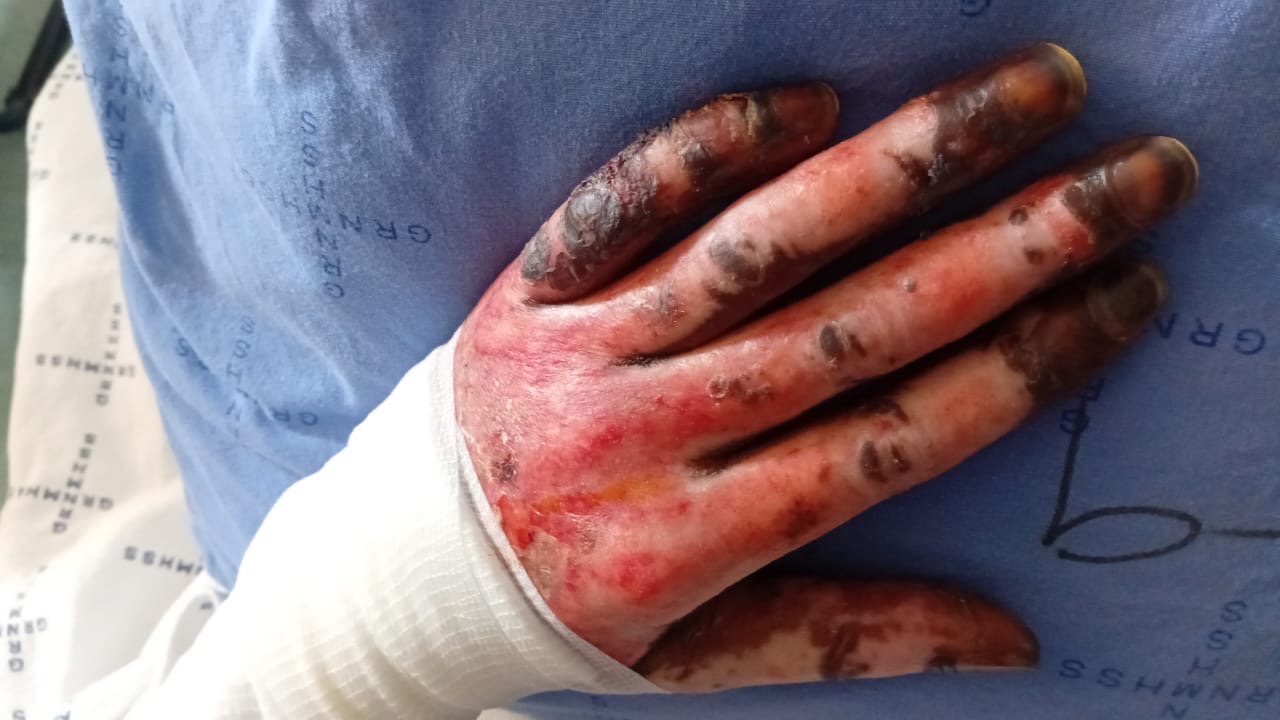 Help John — Himba Leader Severely Burnt in Gas Explosion campaign photo, 6 of 7