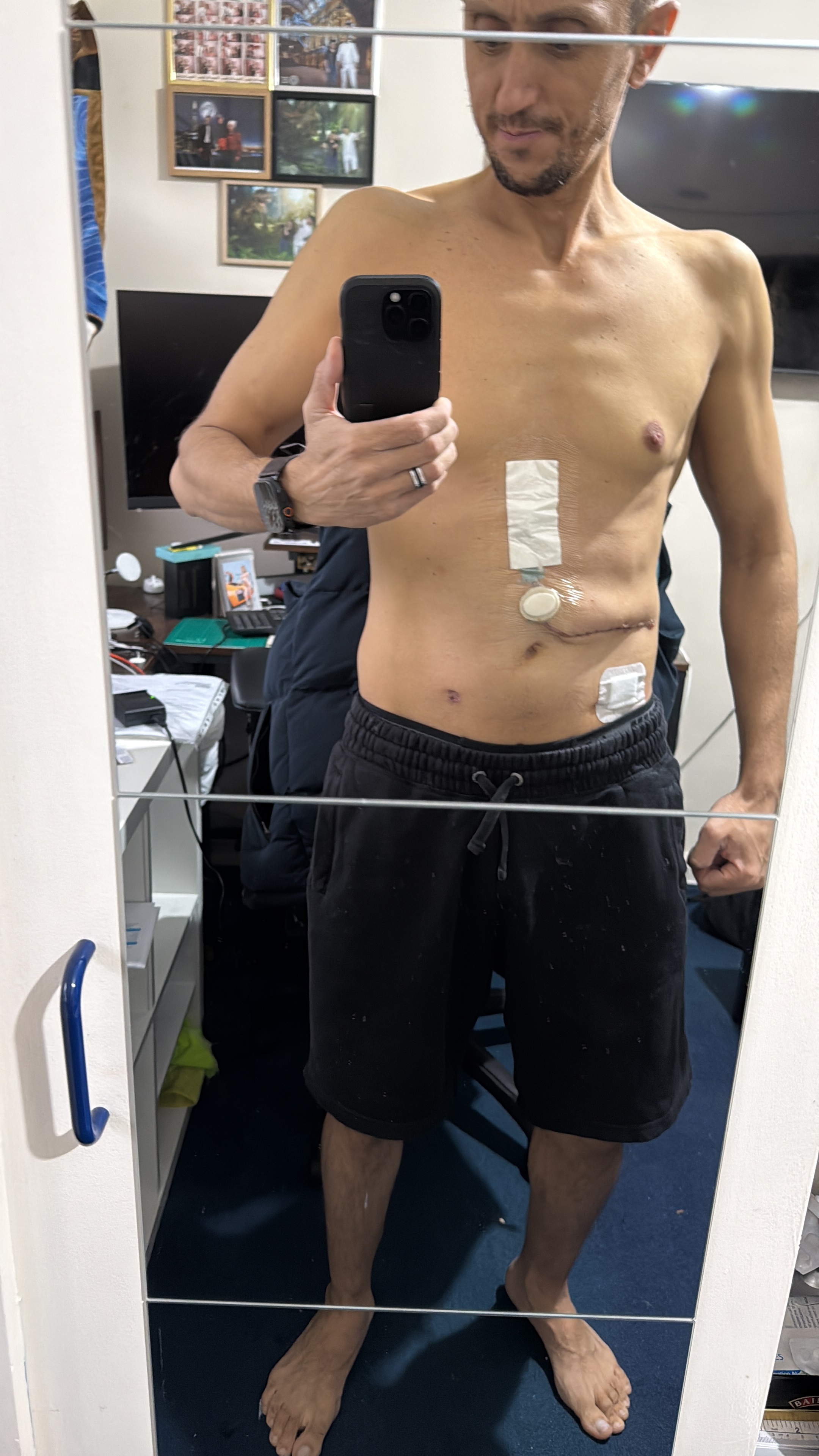 Help Ionut Recover After His Second Liver Transplant Surgery campaign photo, 2 of 7