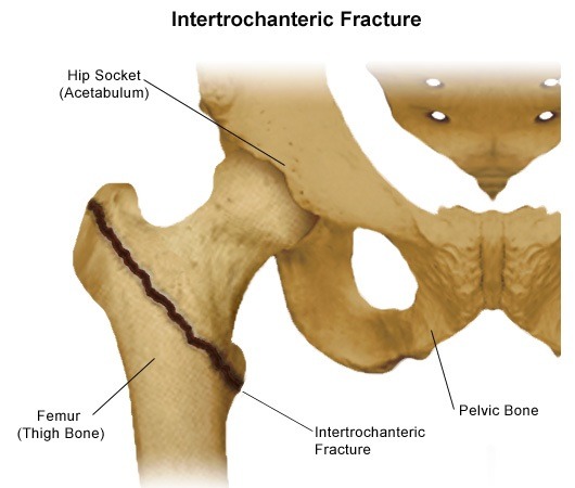 Support Recovery After Hip Surgery campaign photo, 2 of 4