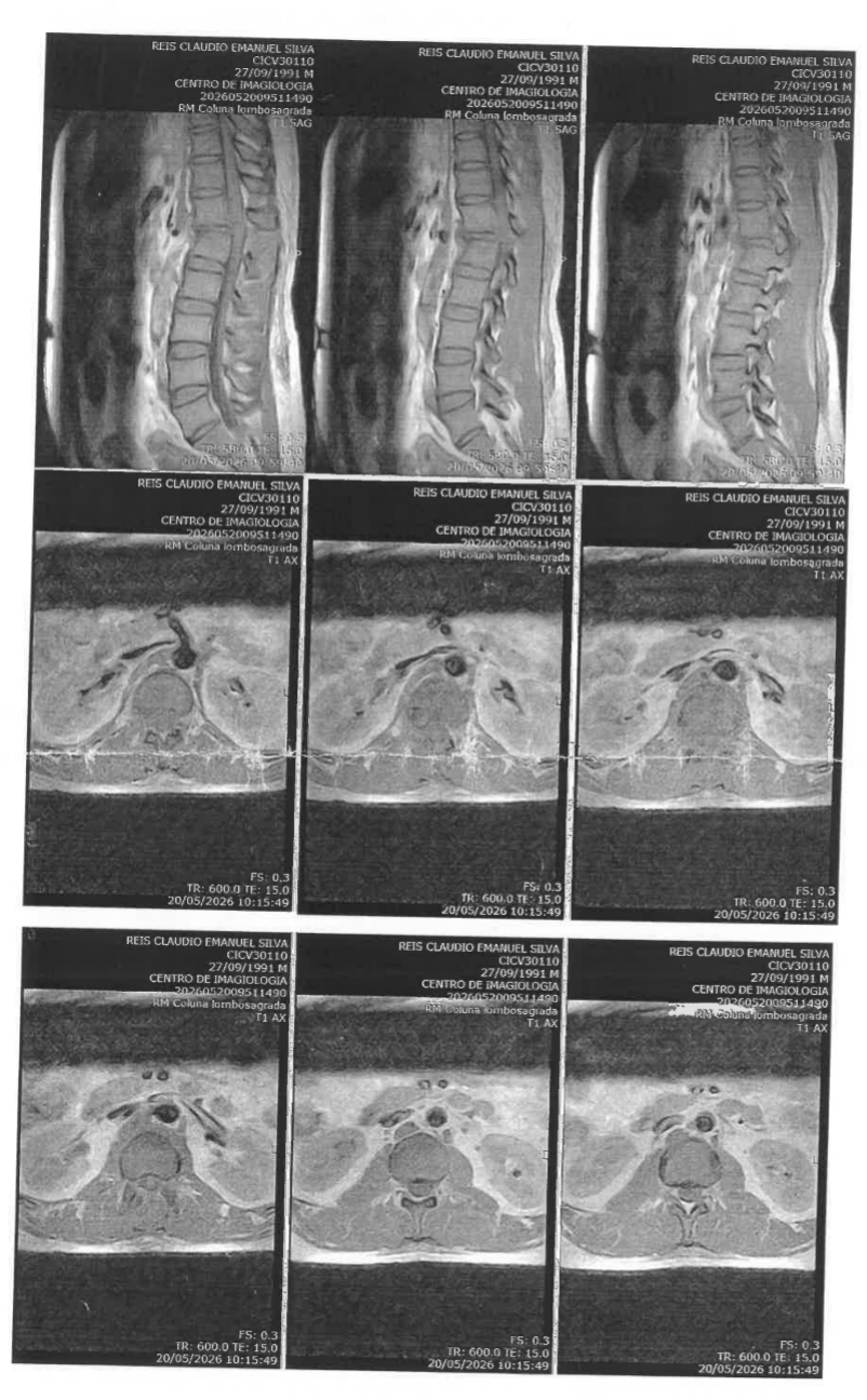 Support Claúdio Emanuel (Gringo) Urgent Spinal Treatment campaign photo, 5 of 8
