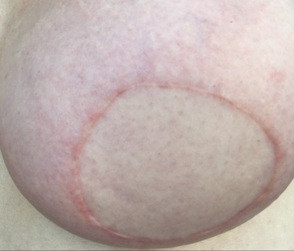 Realistic tattoo training for breast cancer survivors campaign photo, 5 of 7