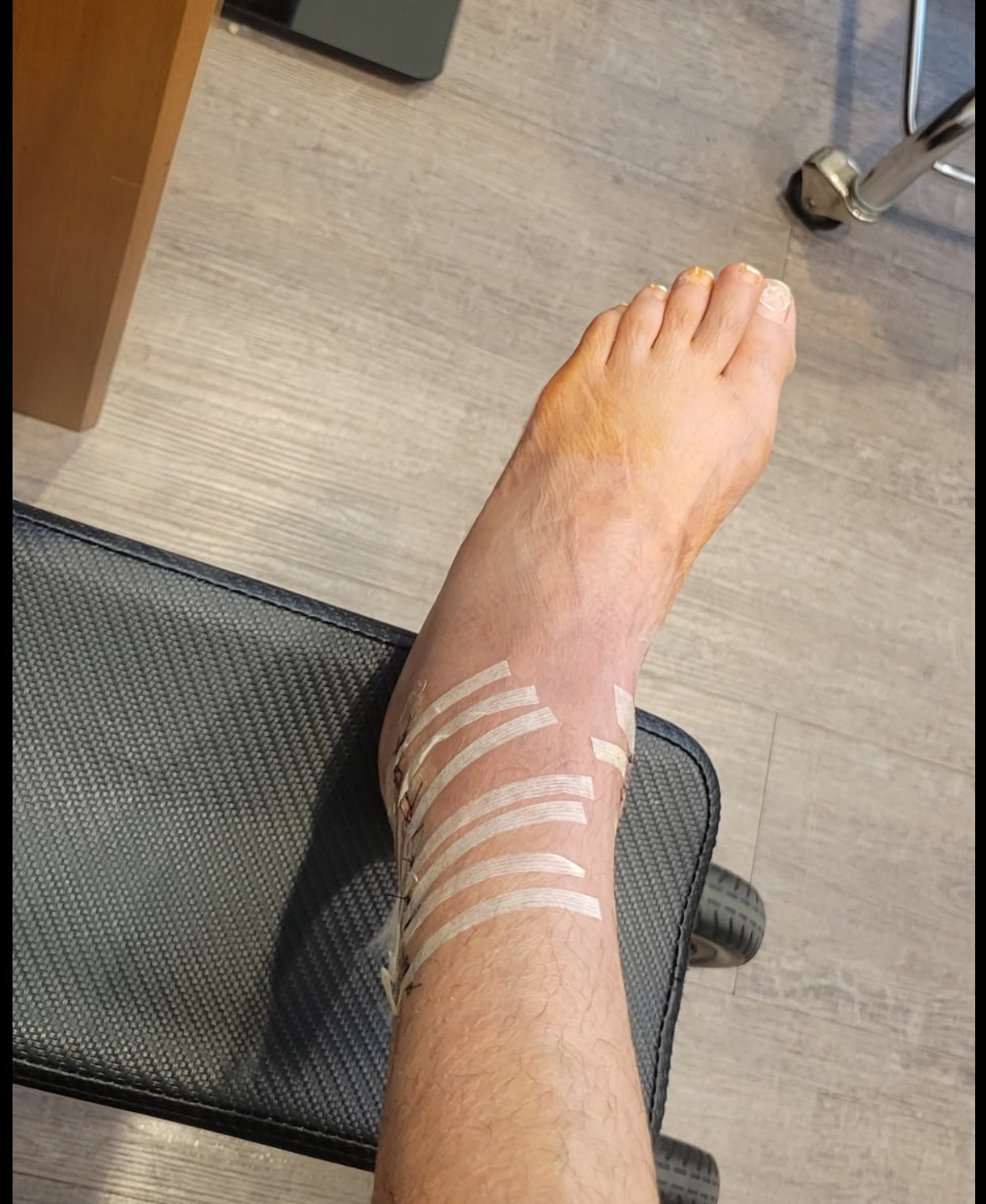 Support Roxane's Second Foot Surgery campaign photo, 2 of 6
