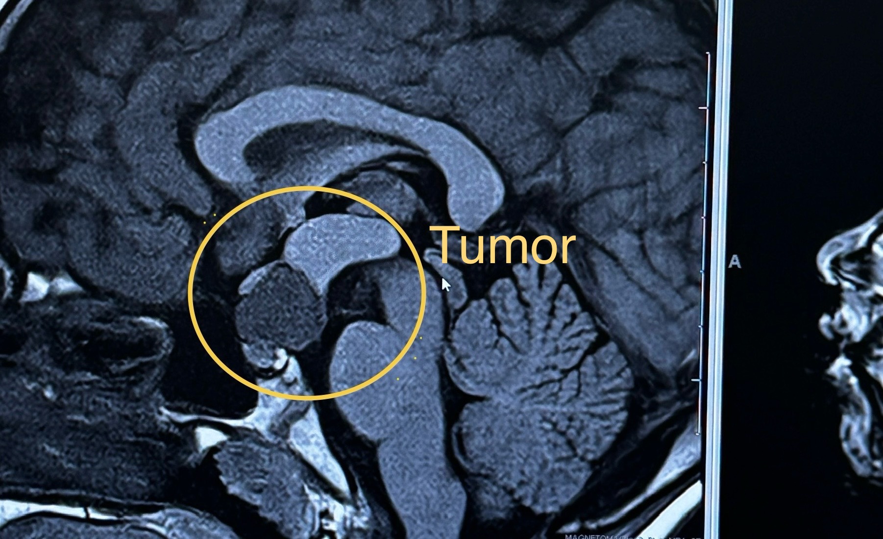 Support Jane's Battle Against Brain Tumor campaign photo, 7 of 8