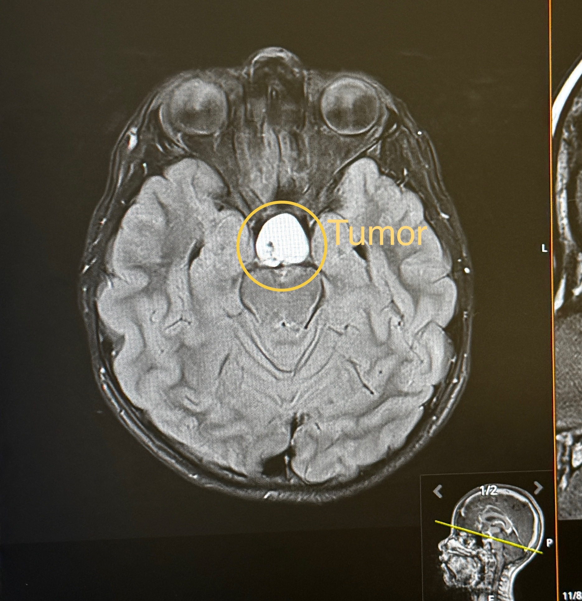Support Jane's Battle Against Brain Tumor campaign photo, 2 of 8