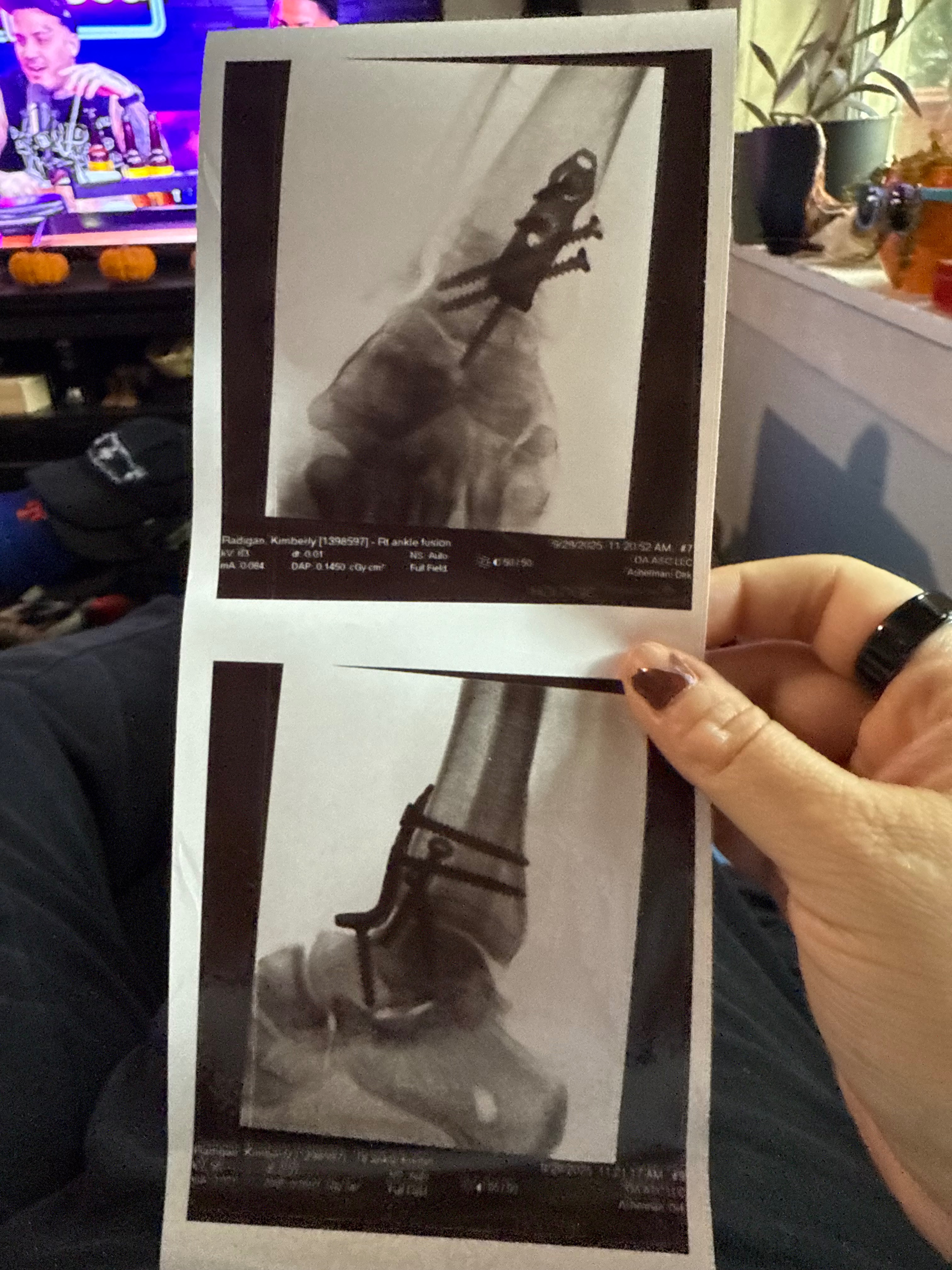 A Little Help While I Heal My Ankle ❤️ campaign photo, 4 of 5