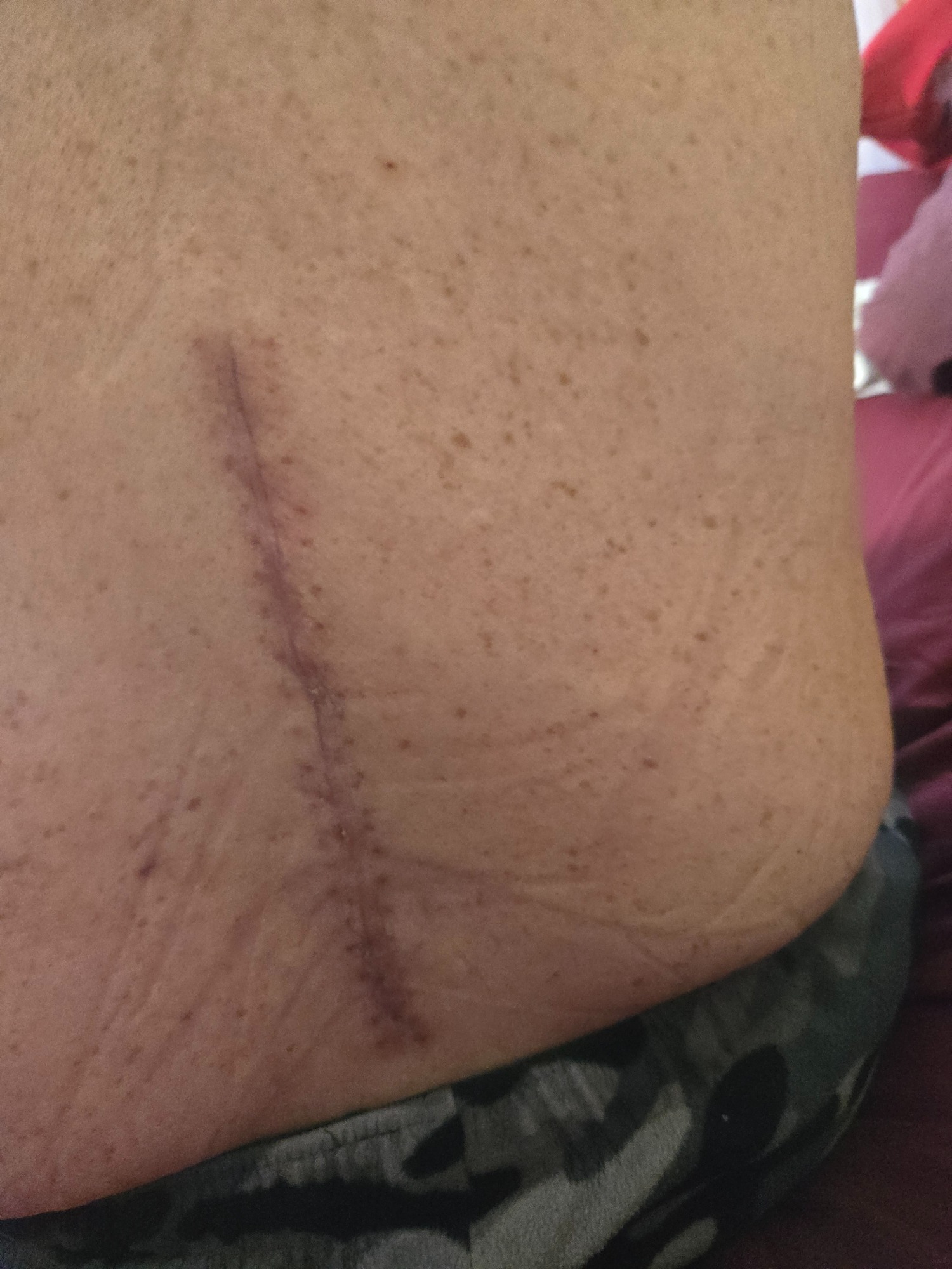 Help Stewart Recover from Spine Surgery campaign photo, 2 of 7