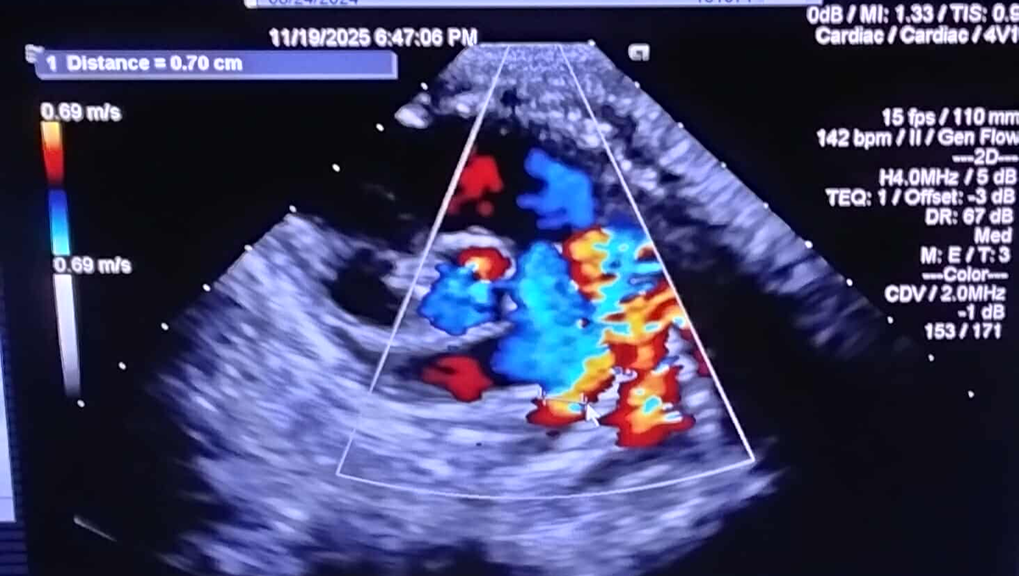 Heart surgery for my niece photo