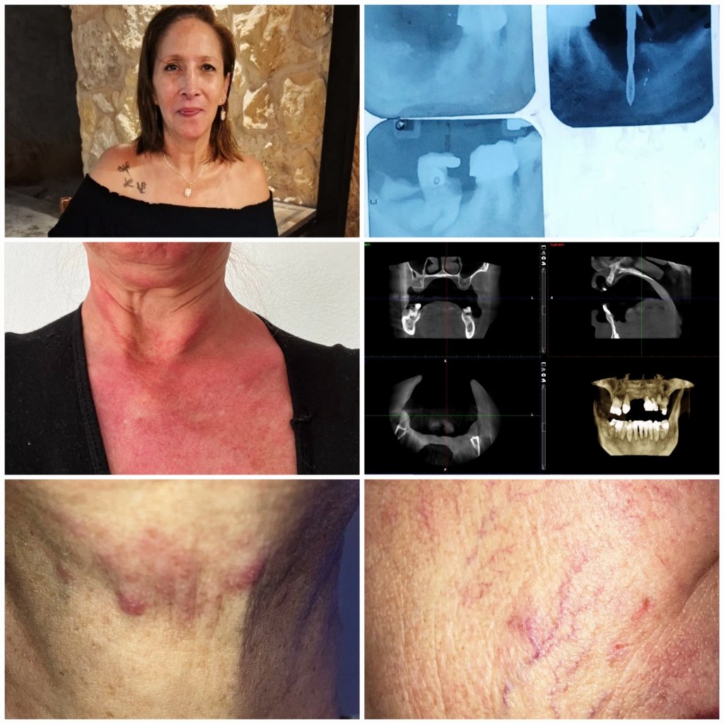 Apoyo a salud de Eli Meza por MCAS y maxilofacial campaign photo, 2 of 4