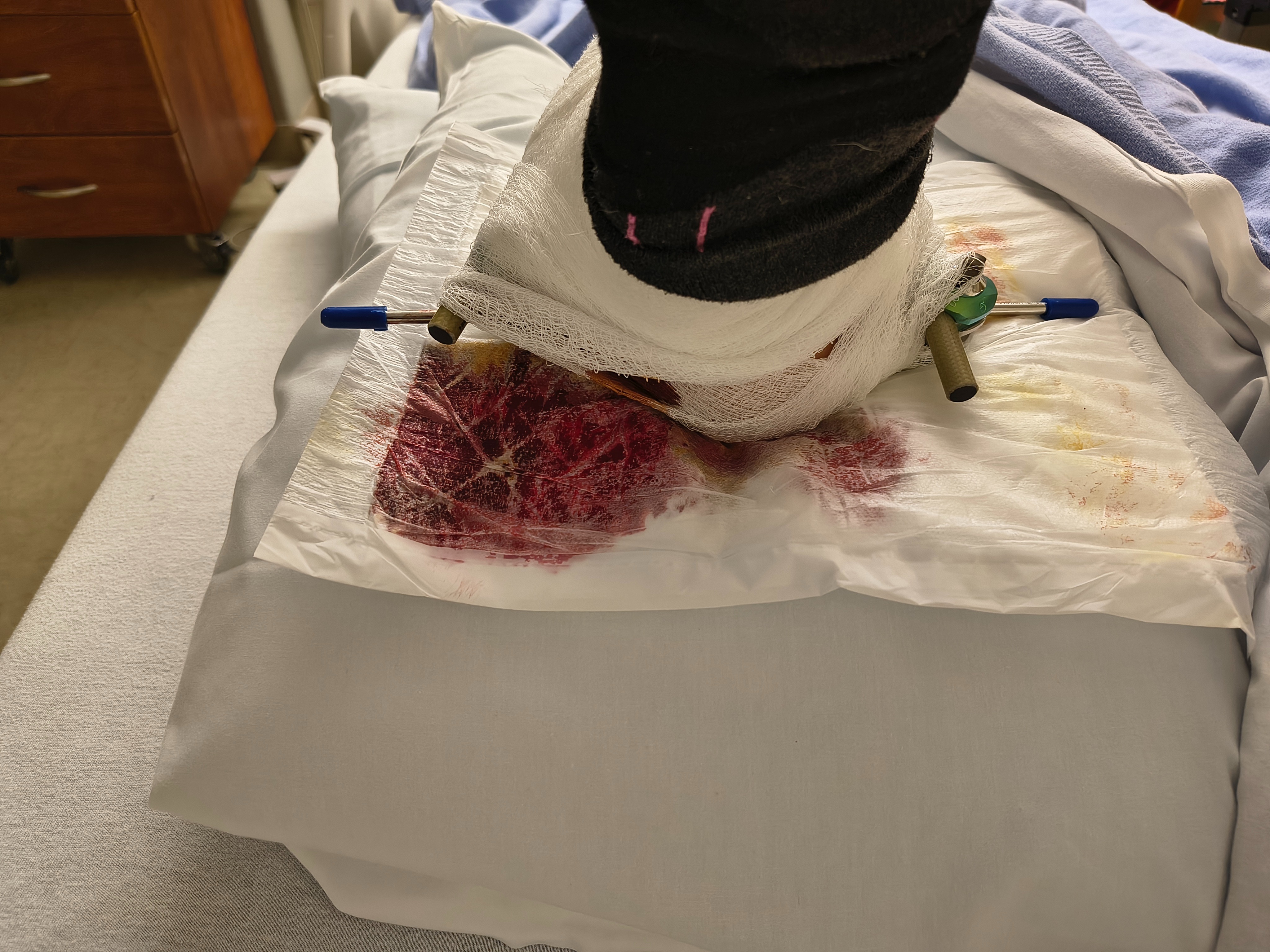 Help Seth Boomhover Heal and Support His Family campaign photo, 4 of 8